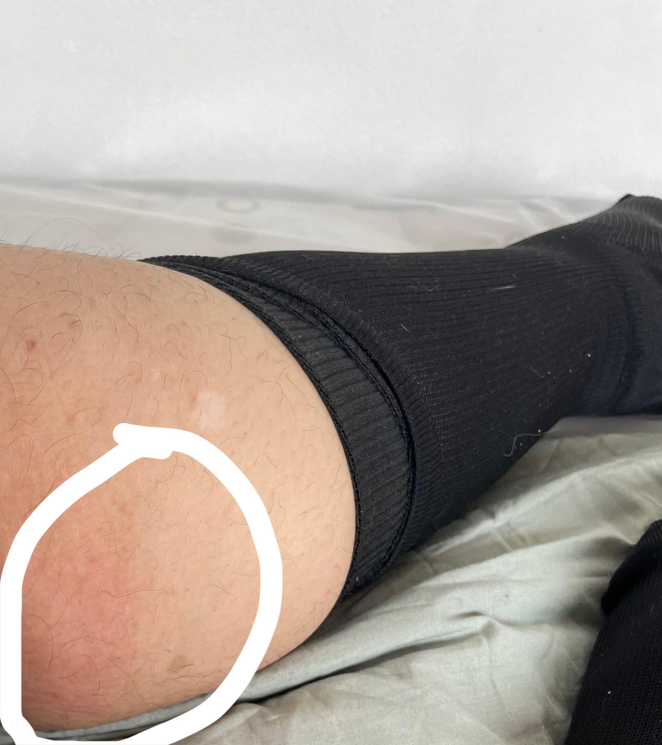 Does this look like a blood clot to you? It's the back part of my upper leg. r/DiagnoseMe