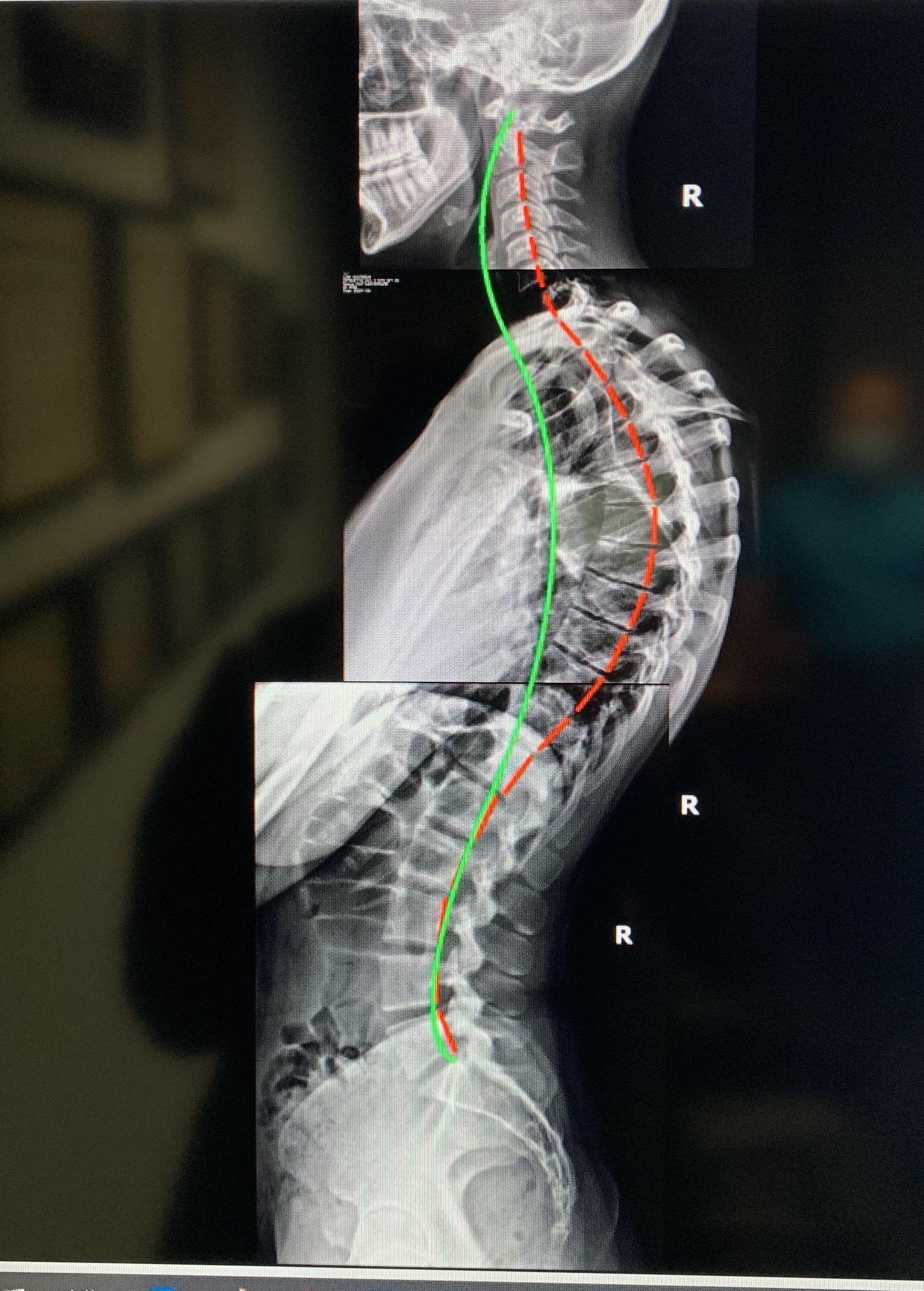 So this chiropractor took some xrays and said he can fix me...I need advice. r/kyphosis