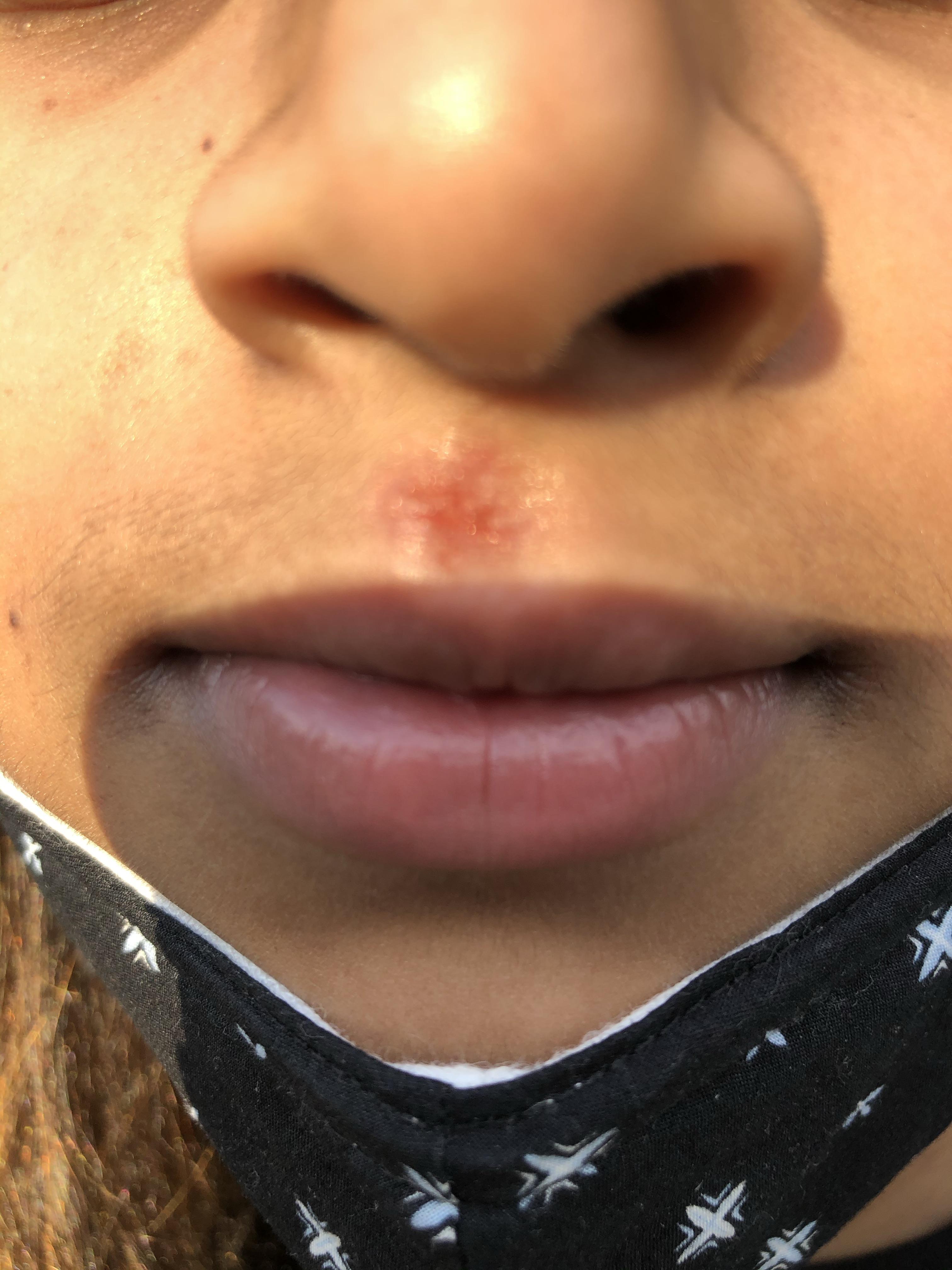 [Skin Concern] Scab/Rash on Upper Lip r/SkincareAddiction