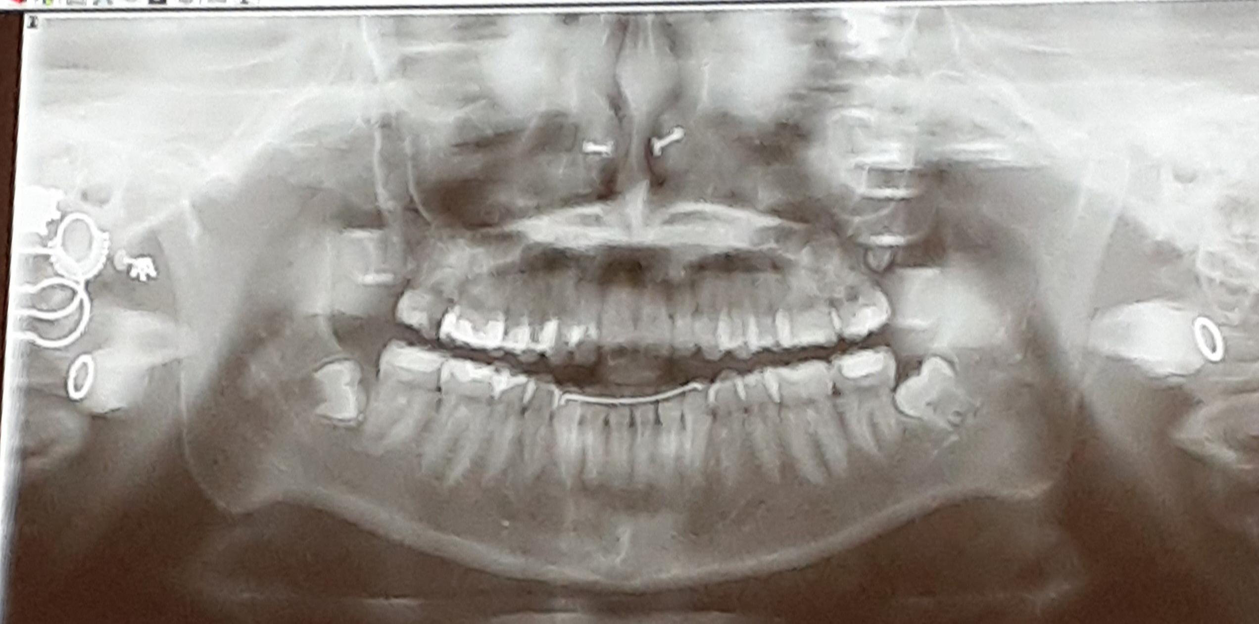 Got my wisdom teeth out today. Peep the nose rings and all my ear