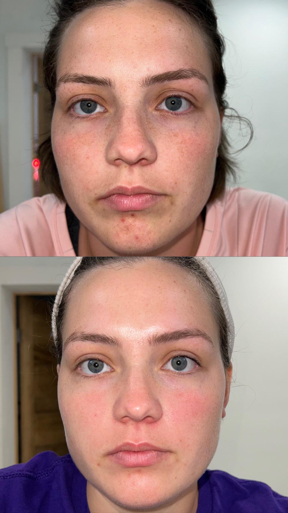 Amazing results after 30 days of using red light therapy. r