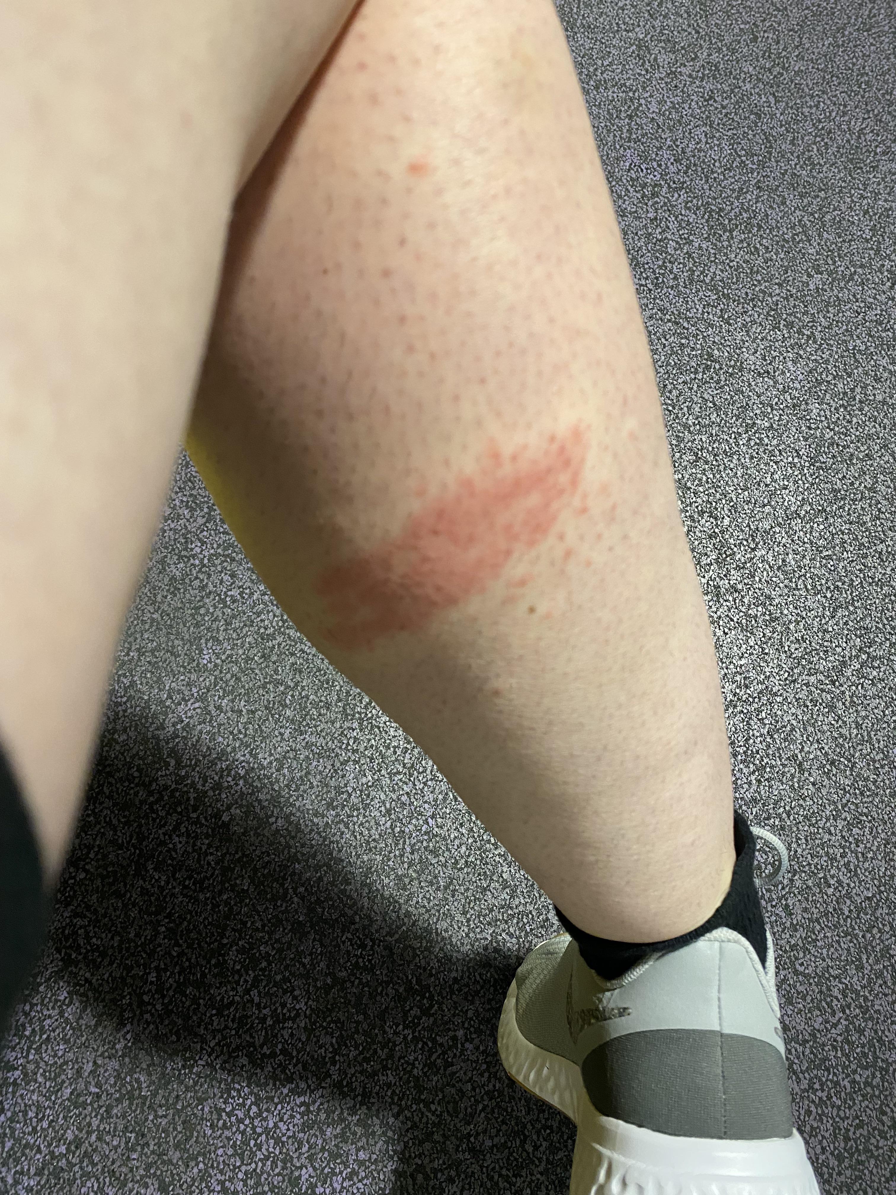 Rash on back of legs r/medical
