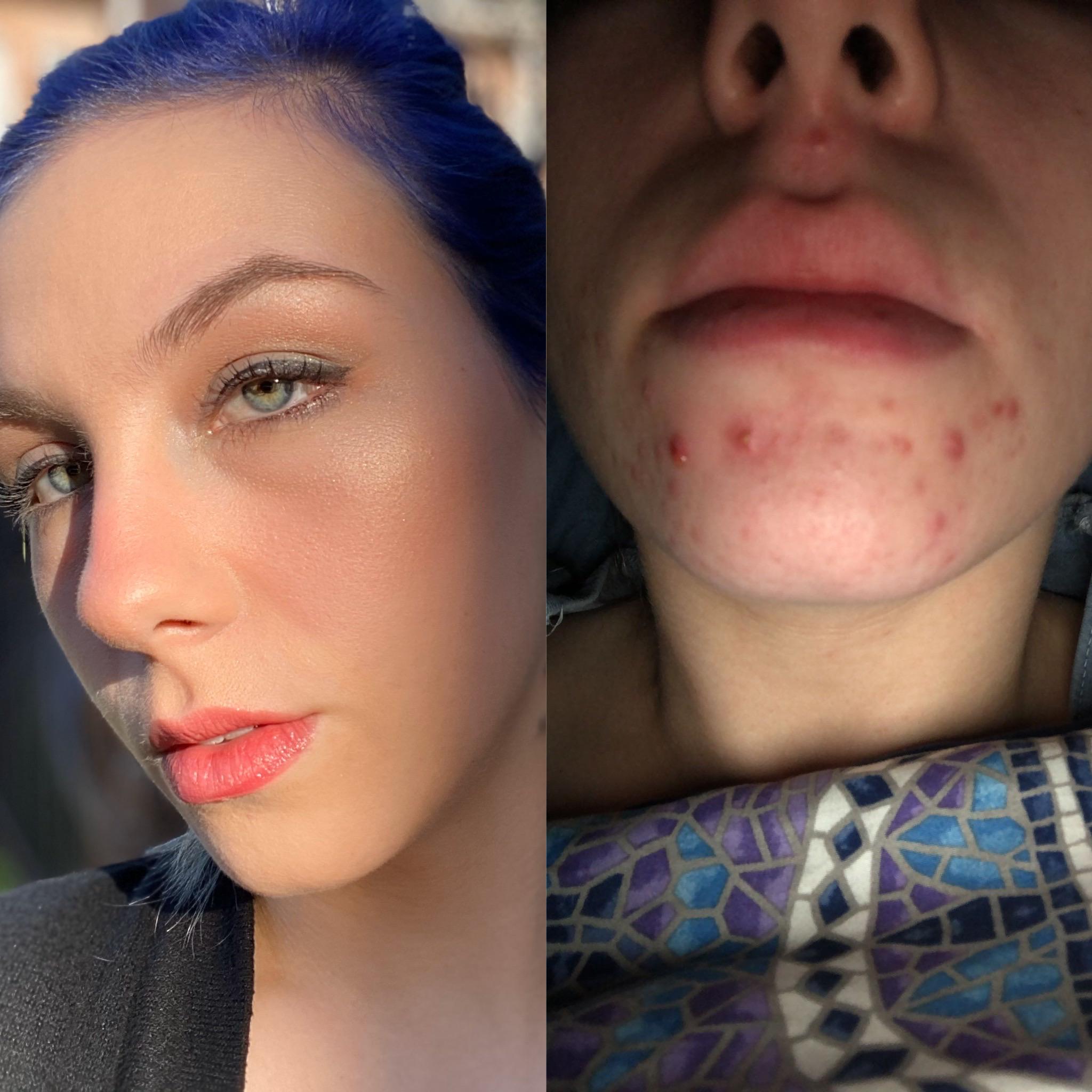 Hormonal acne is finally under control after 10 years ,) products in