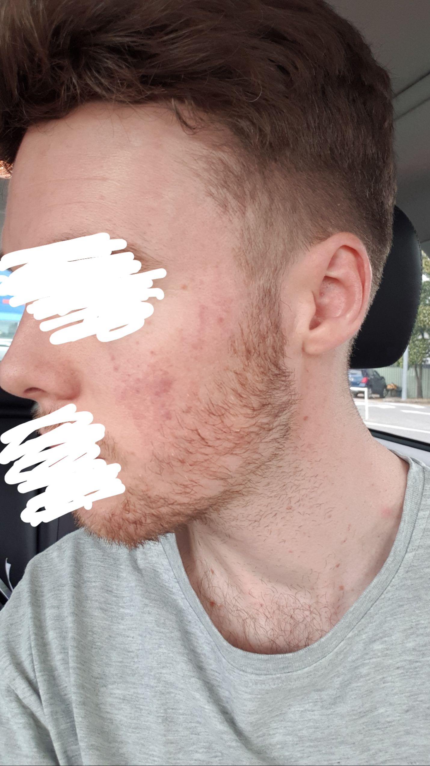 Cannot find a trigger... no dairy, sugar, sun, heat, hot drinks