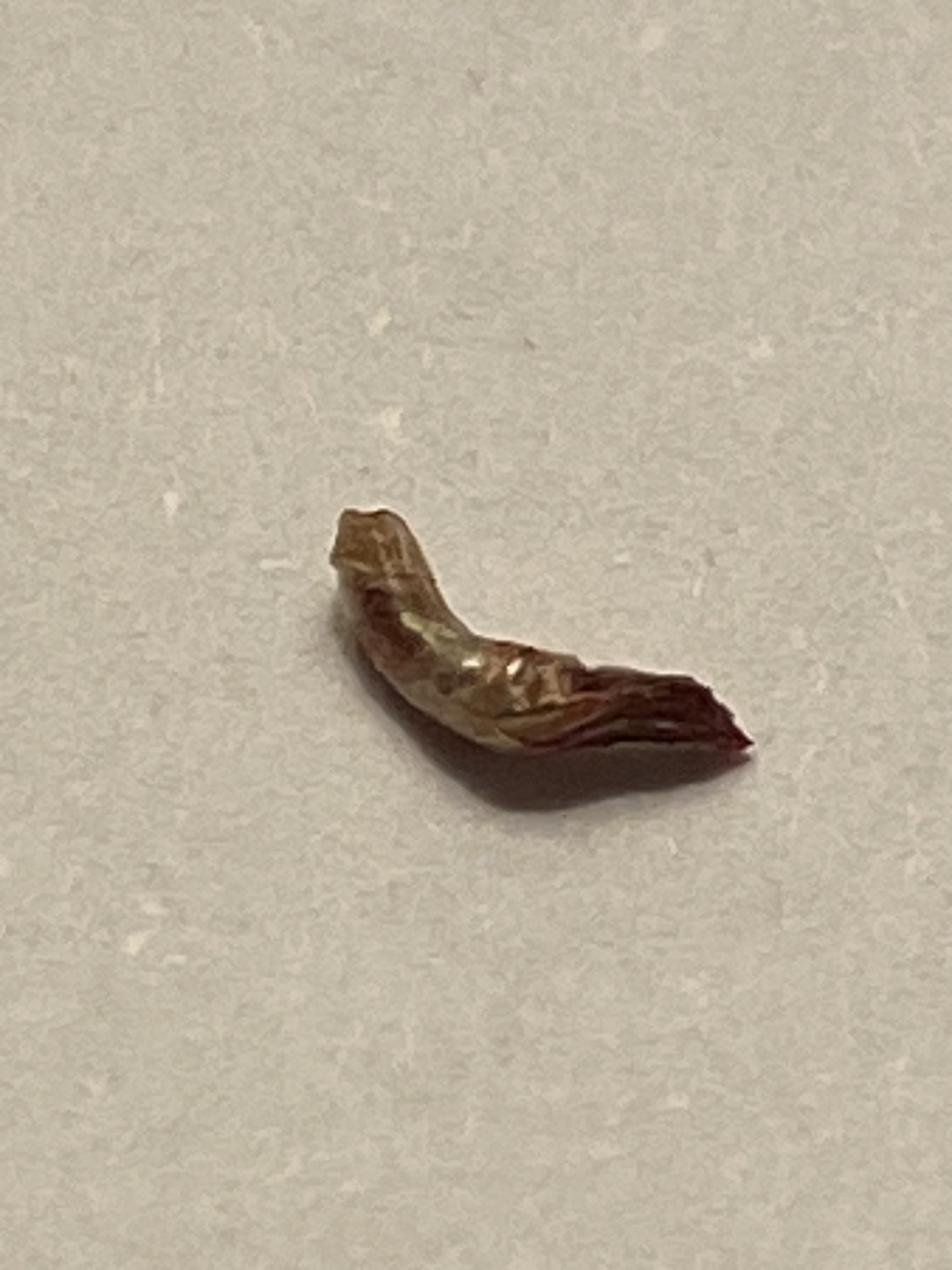 I have Pili Multigemini (multiple hairs growing out of one follicle). I