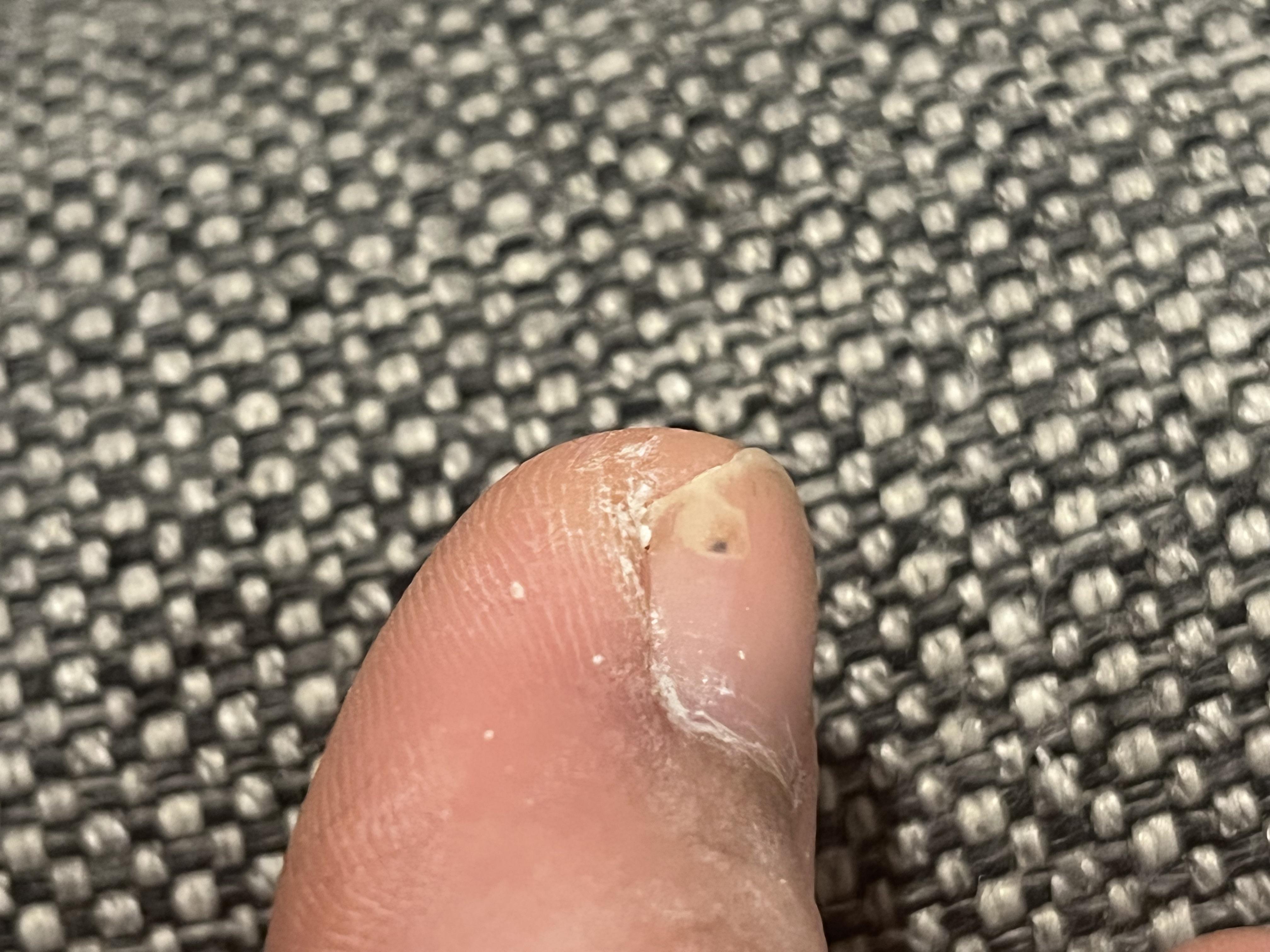 Dark spot under nail r/medical_advice