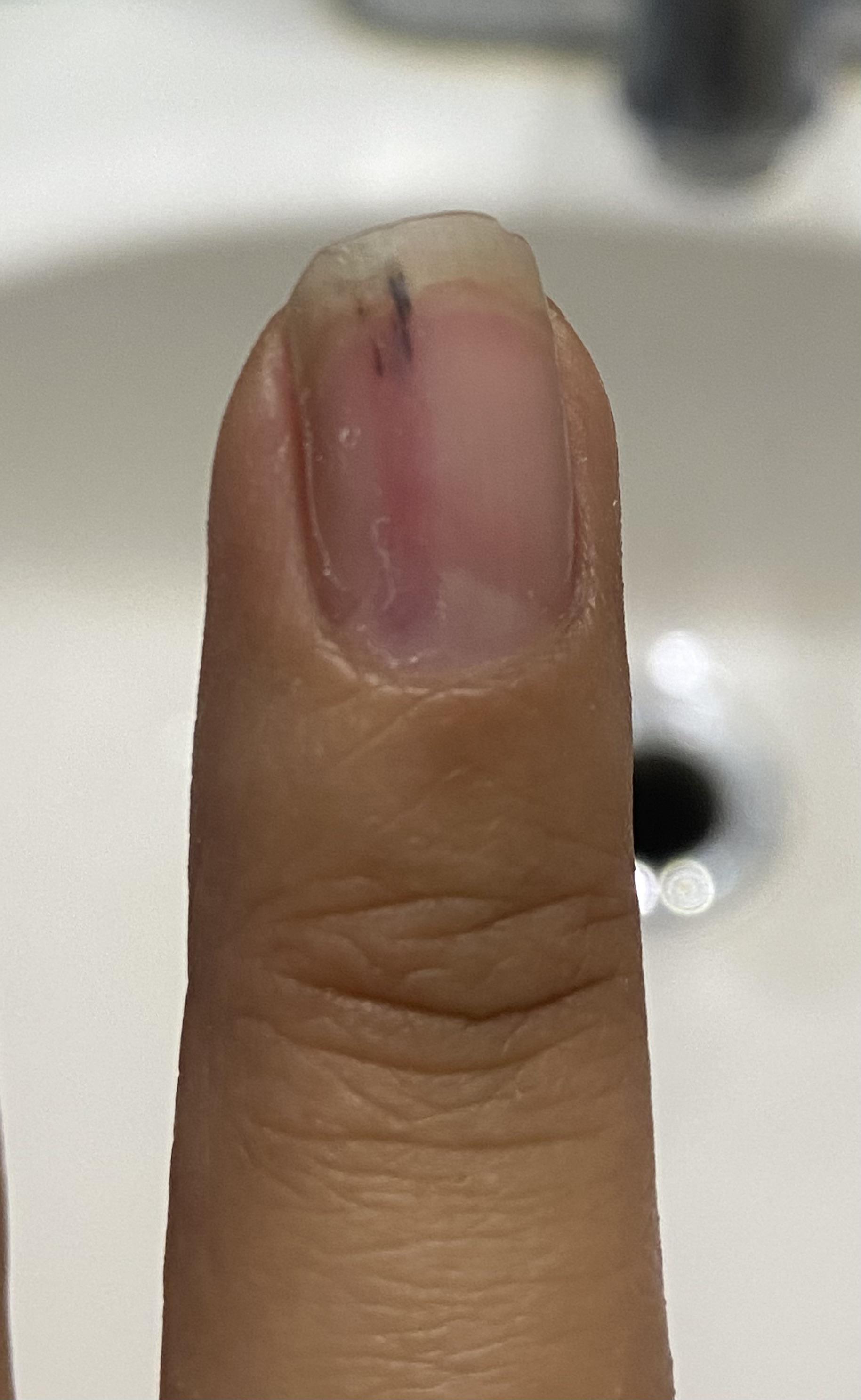 Is this a splinter hemorrhage? r/DermatologyQuestions