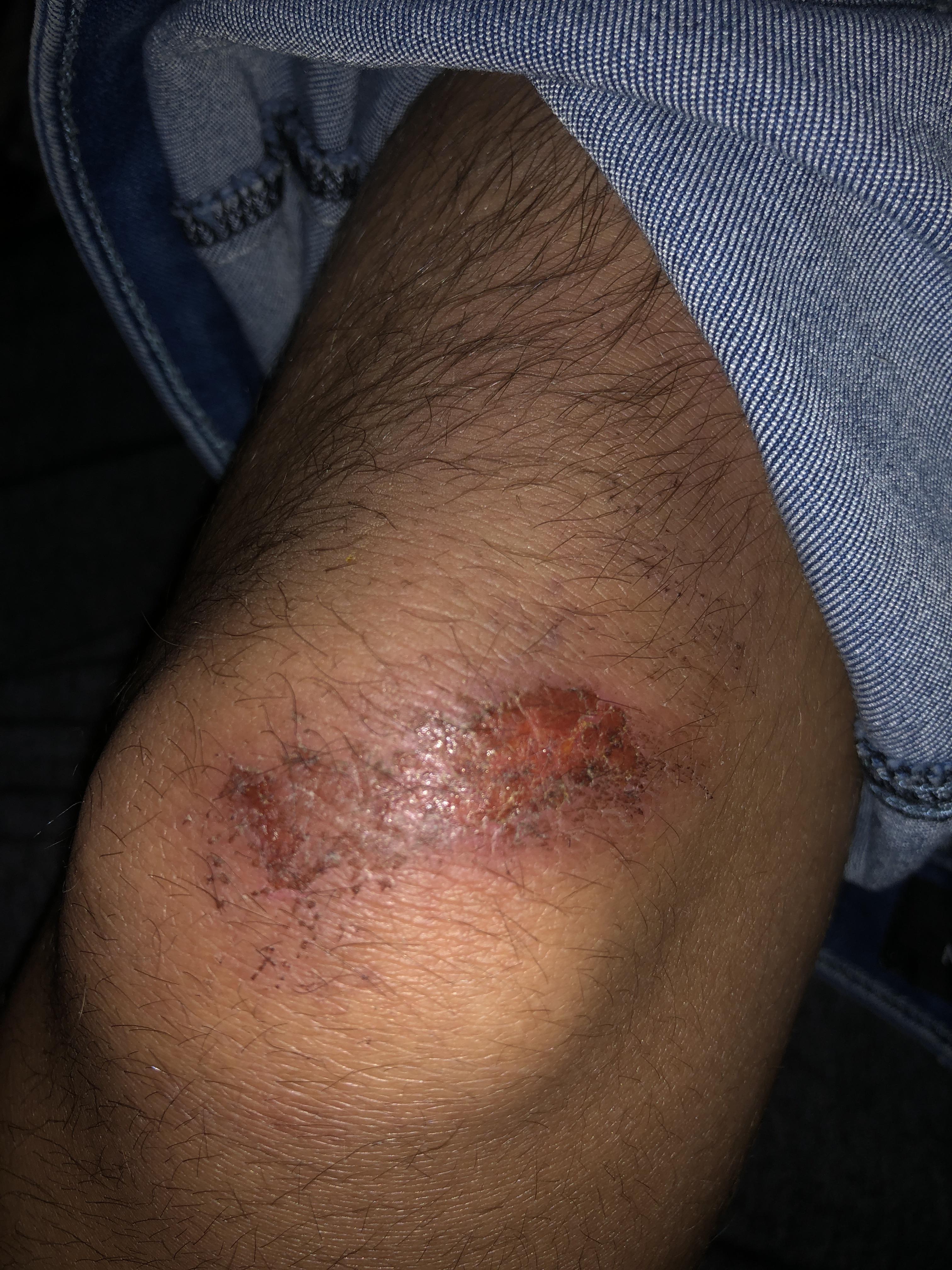 Anyone know if this wound is infected? Got a pretty bad turf burn on