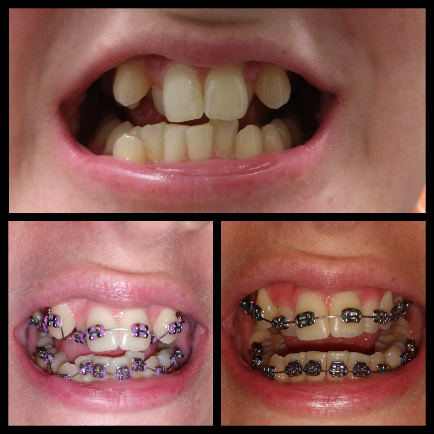 Three month progress 😊😊😊 r/braces
