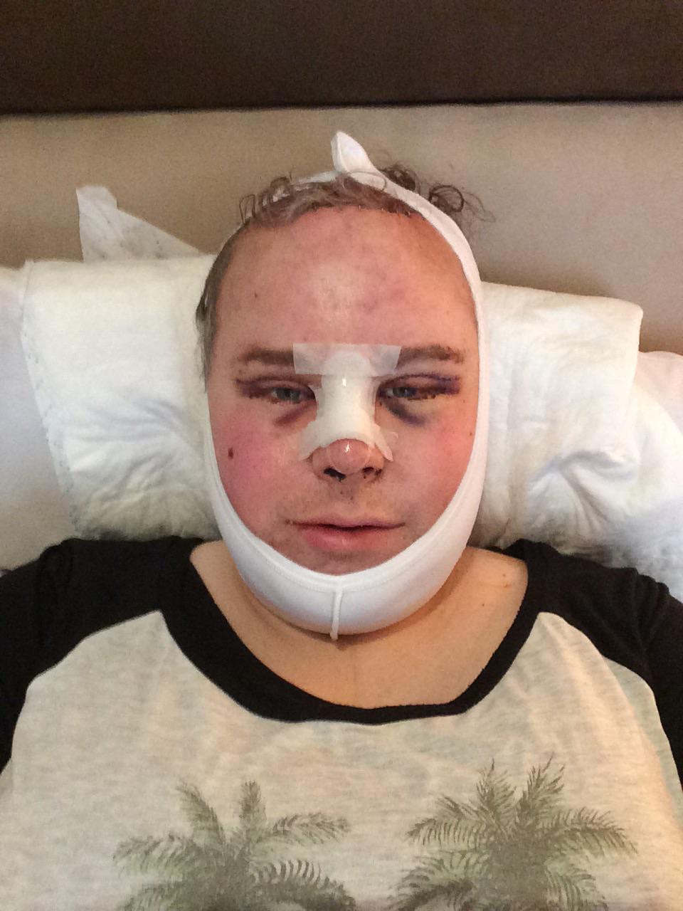 425 best r/transgender_surgeries images on Pholder Day 1 of recovery