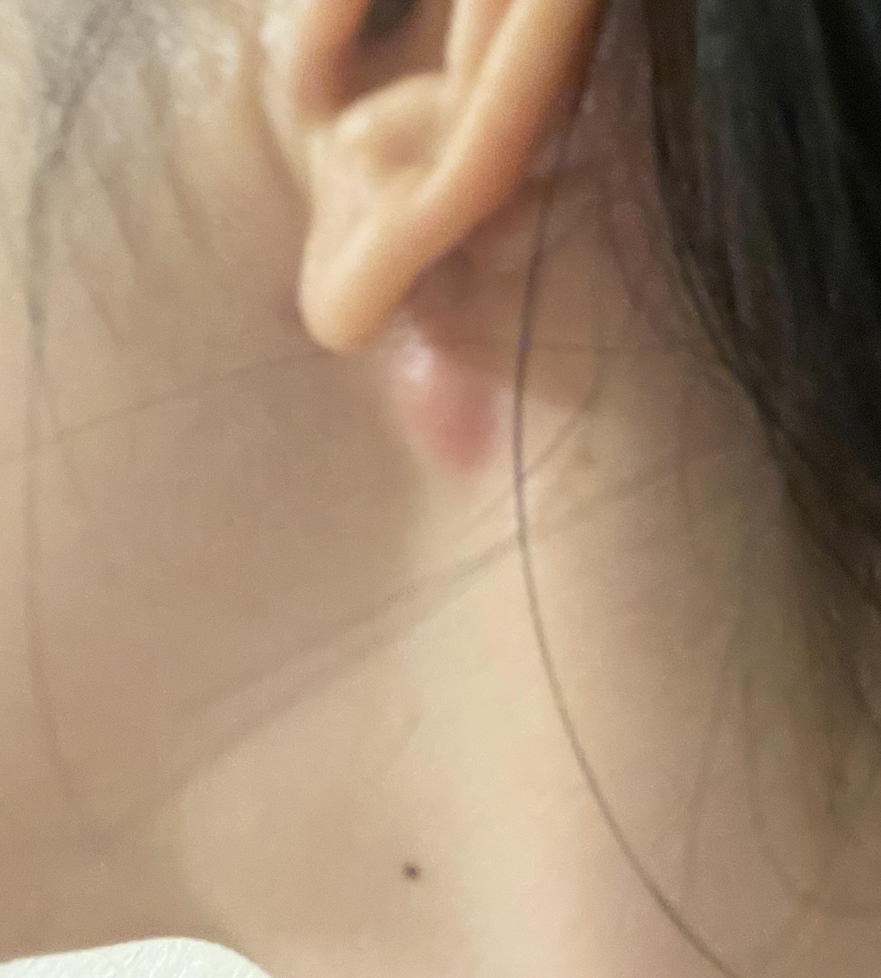 What kind of bump is this? : r/30PlusSkinCare