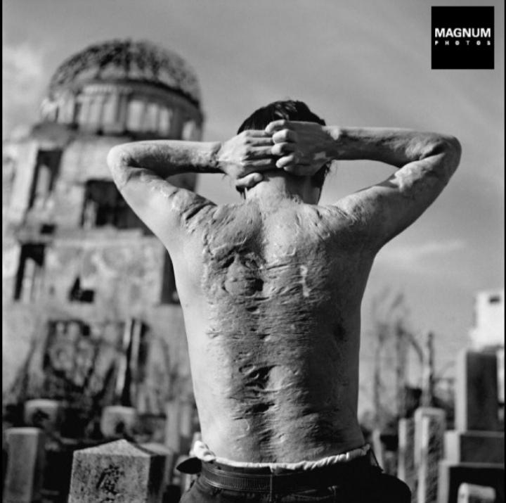A Hiroshima ABomb victim shows his scars, 6 years after the bomb. r/pics