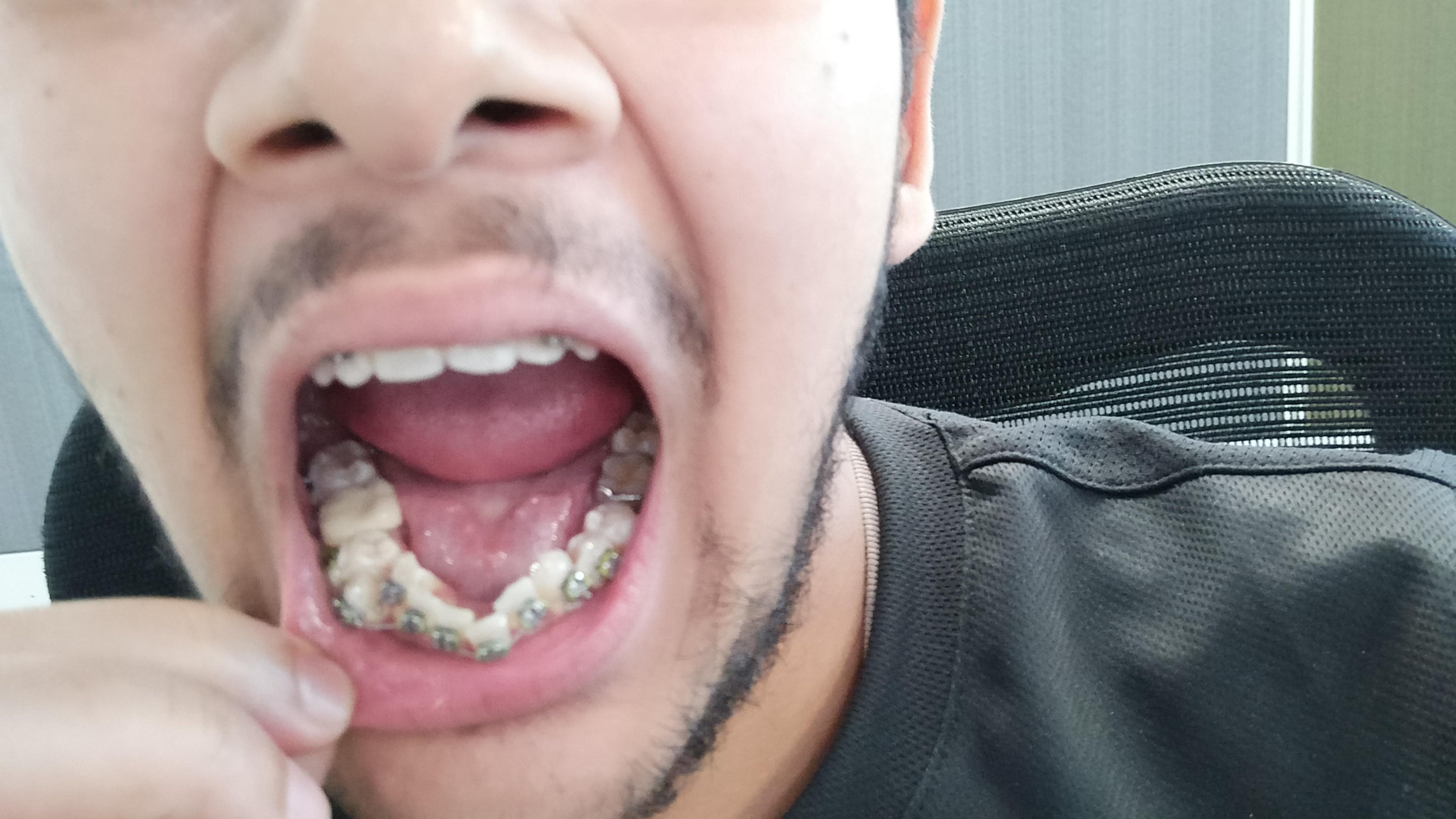 Dentists of Reddit. Should I go for an extraction? r/braces