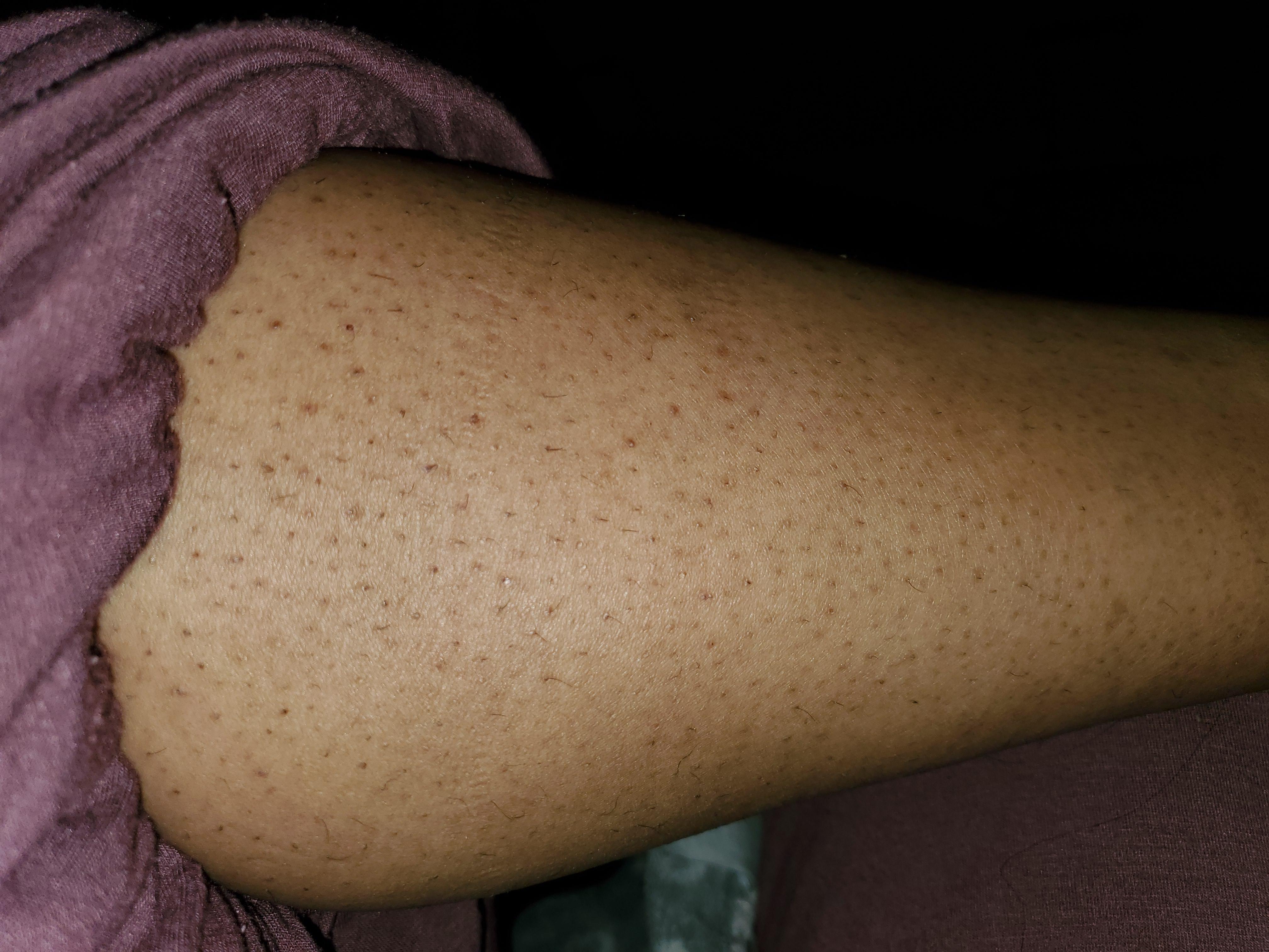 [skin concern] why does the hair on my legs grow under the skin? It's