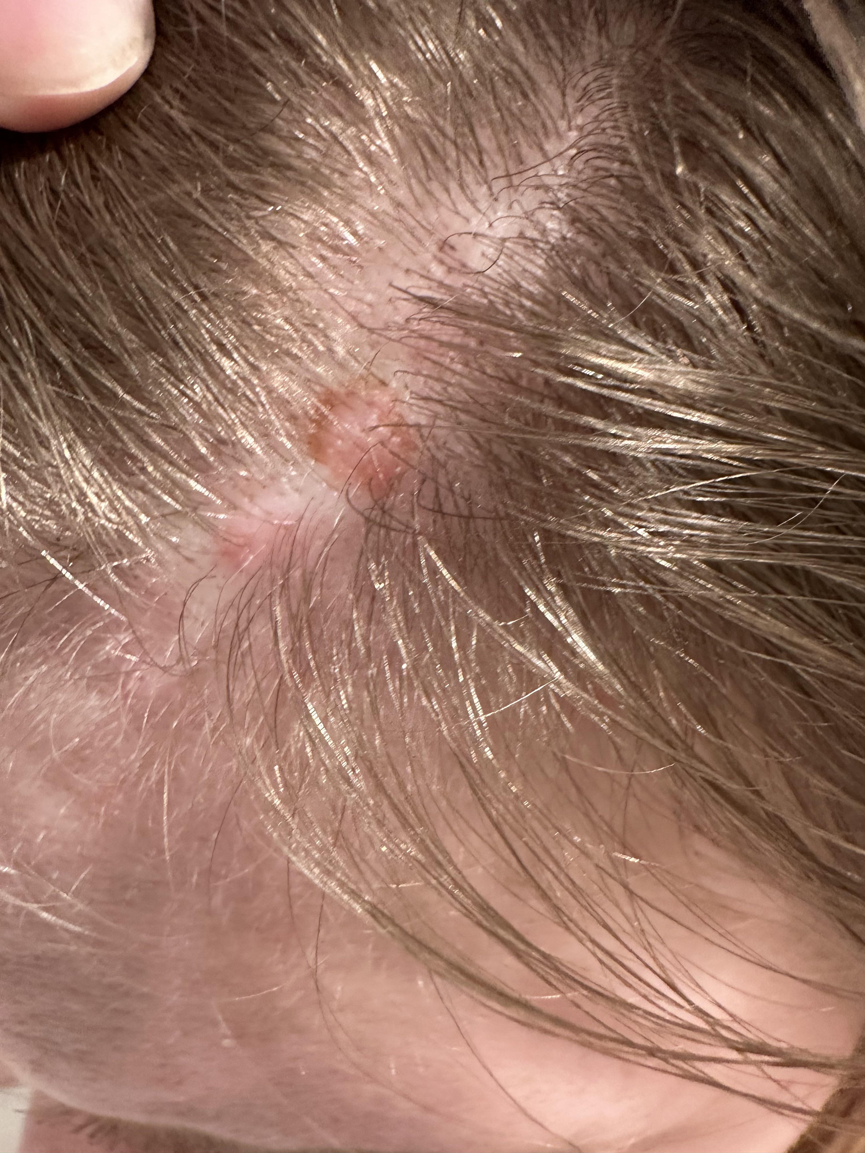 weird spot on scalp help please! r/Haircare