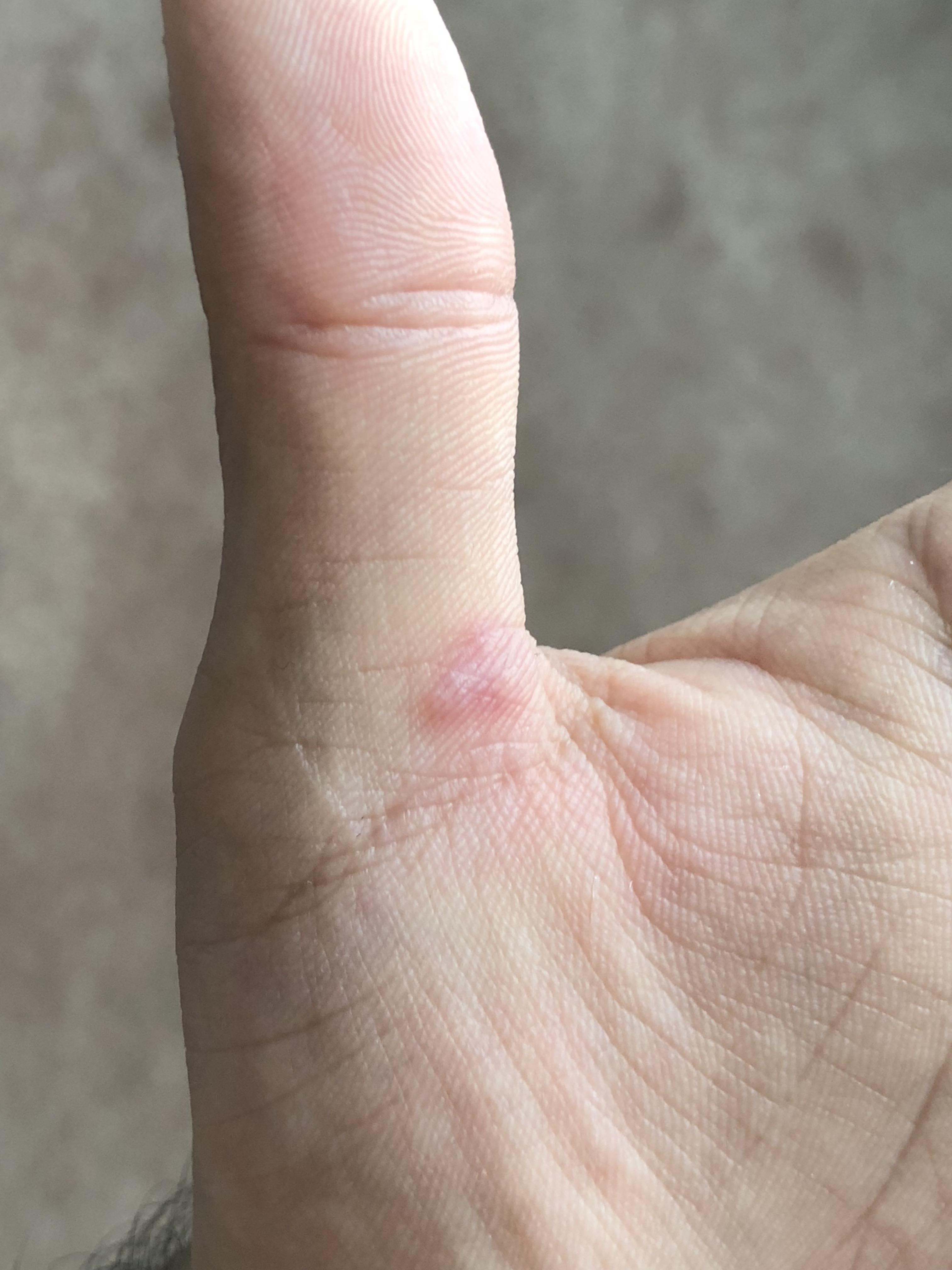 Clusters of reddish bumps on various areas of my left hand, wrist, and