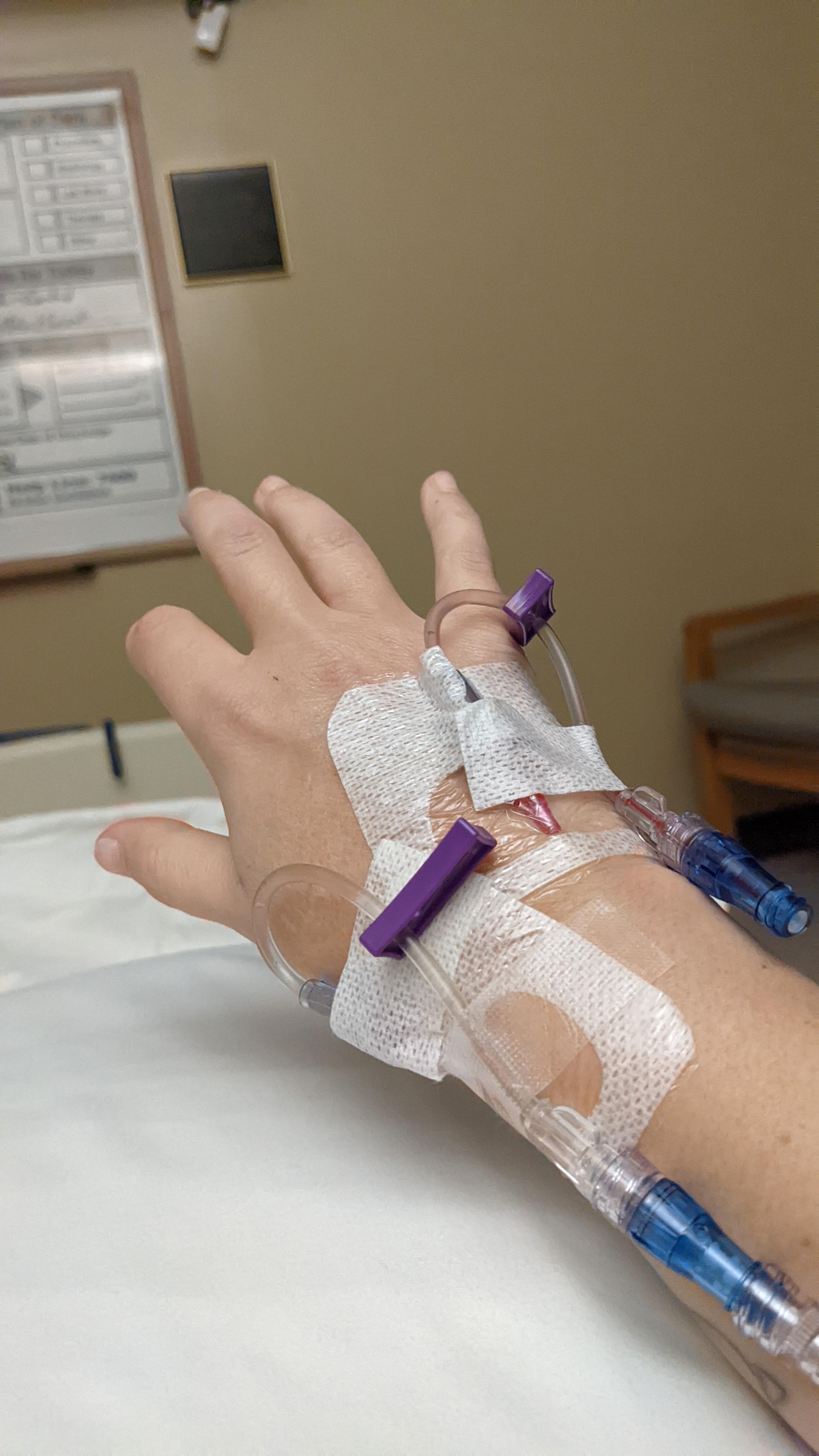 In the hospital right now recovering from surgery. My IV is causing my