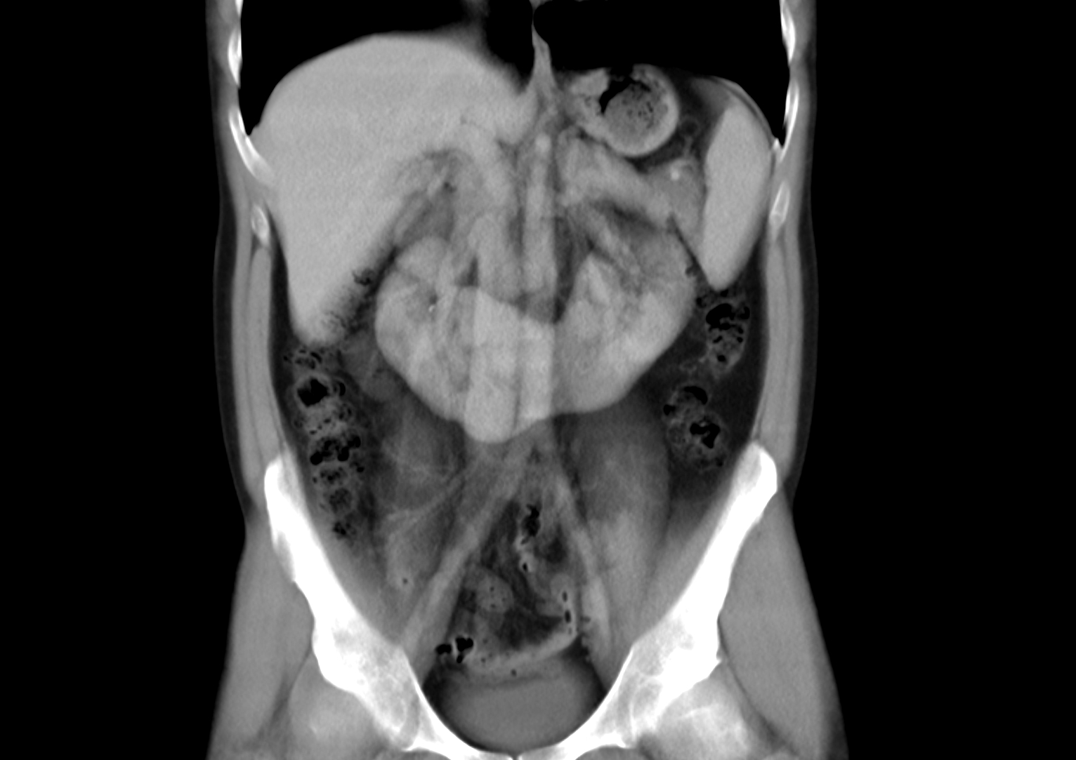 Horse shoe kidney r/Radiology