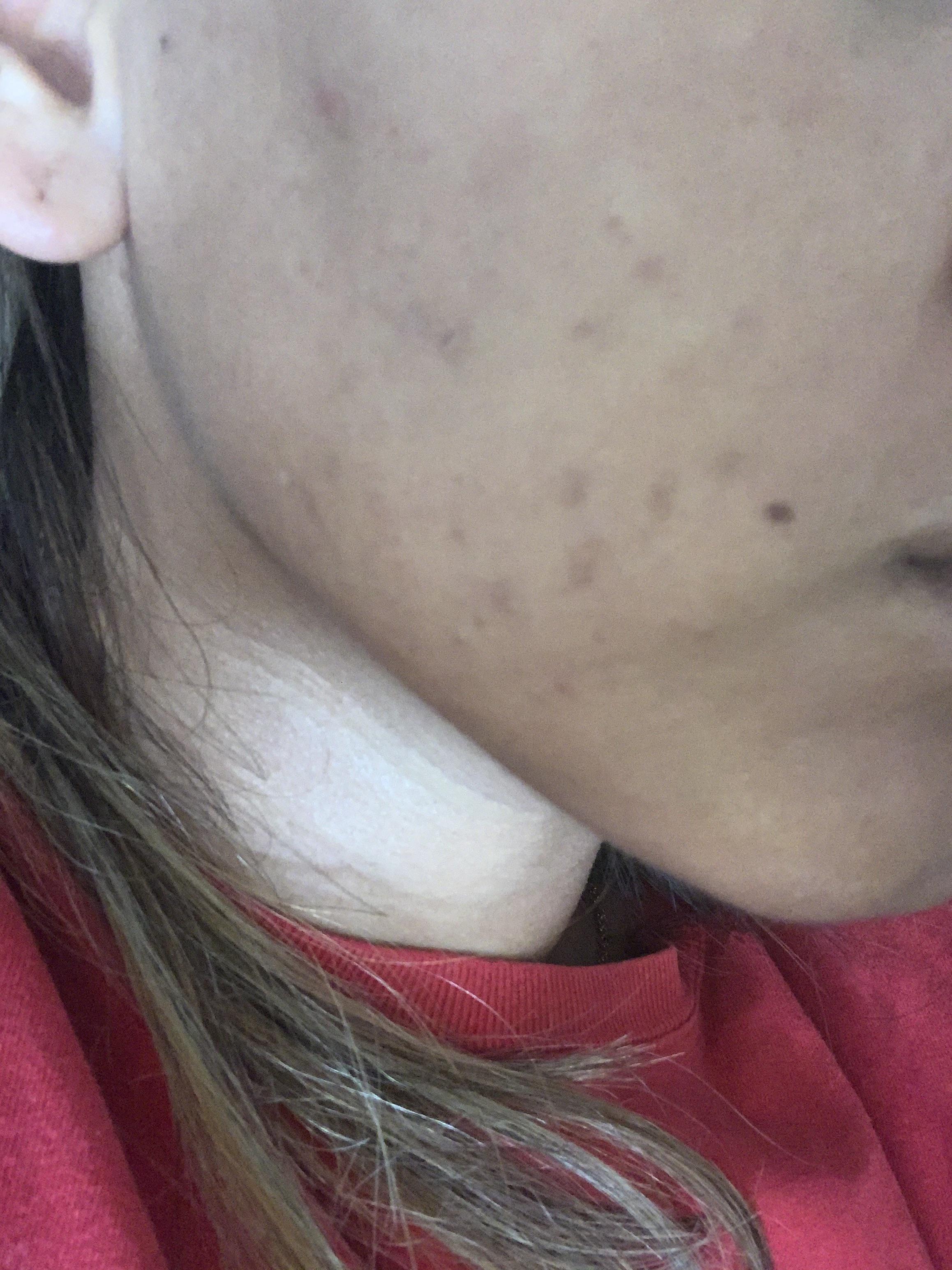 [Acne] from wearing face masks, any advice? r/SkincareAddiction