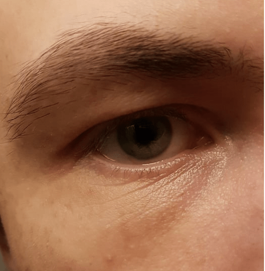 [Skin Concerns] Wrinkles under eye in early 20s? r/SkincareAddiction