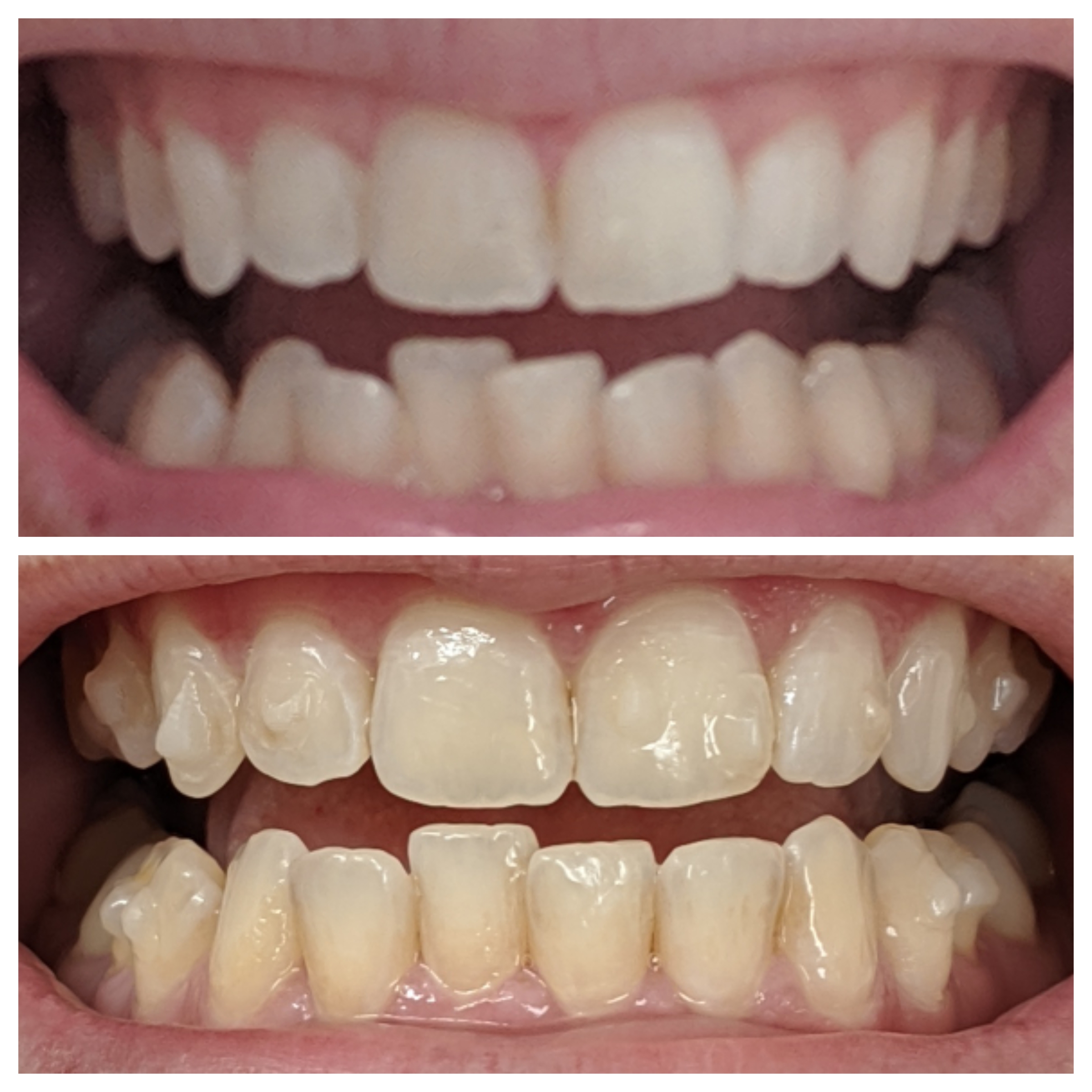 Tray 8/14. I can't believe how much they've already moved! Invisalign