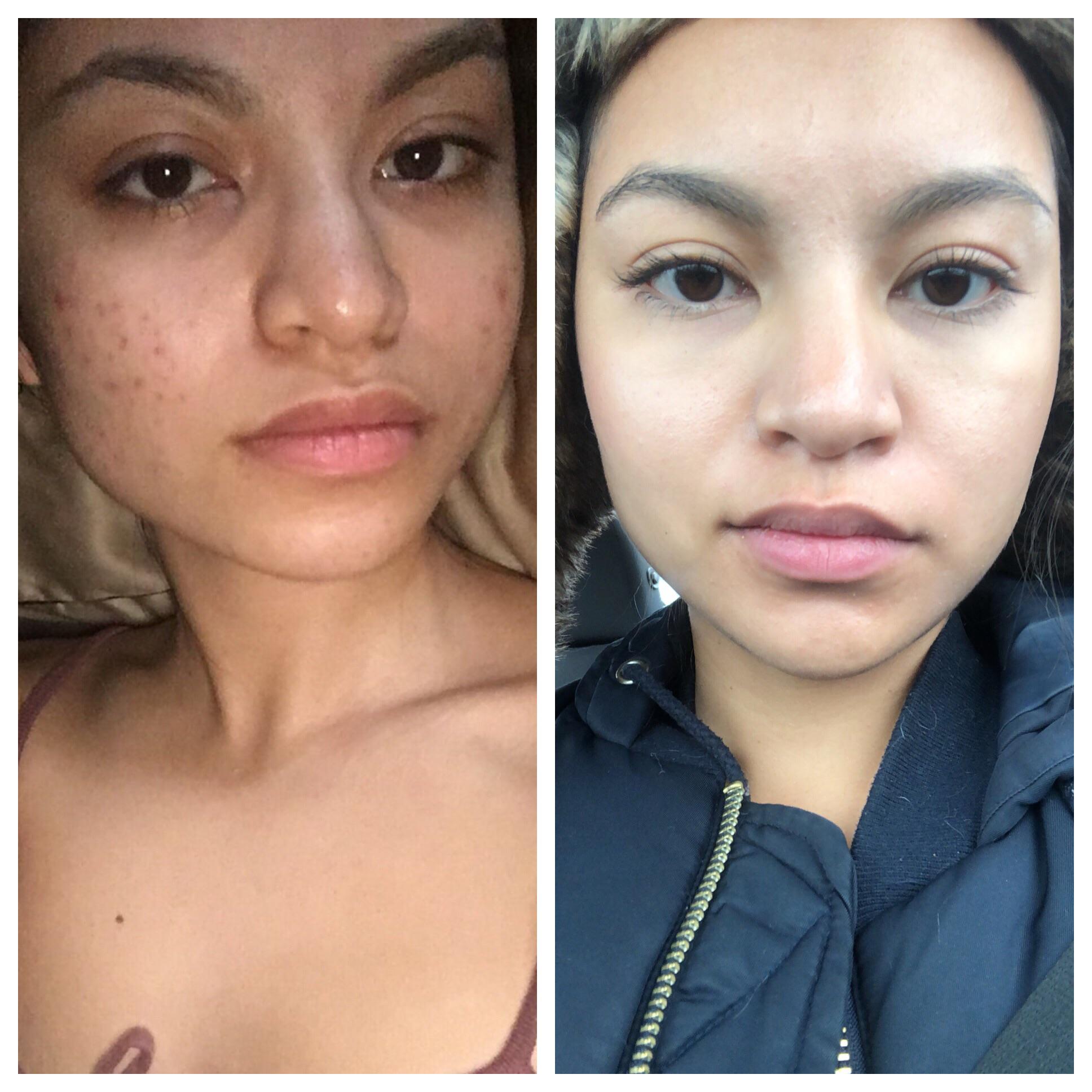 [Skin Concerns] Cleared my cheek acne. I need help with the redness