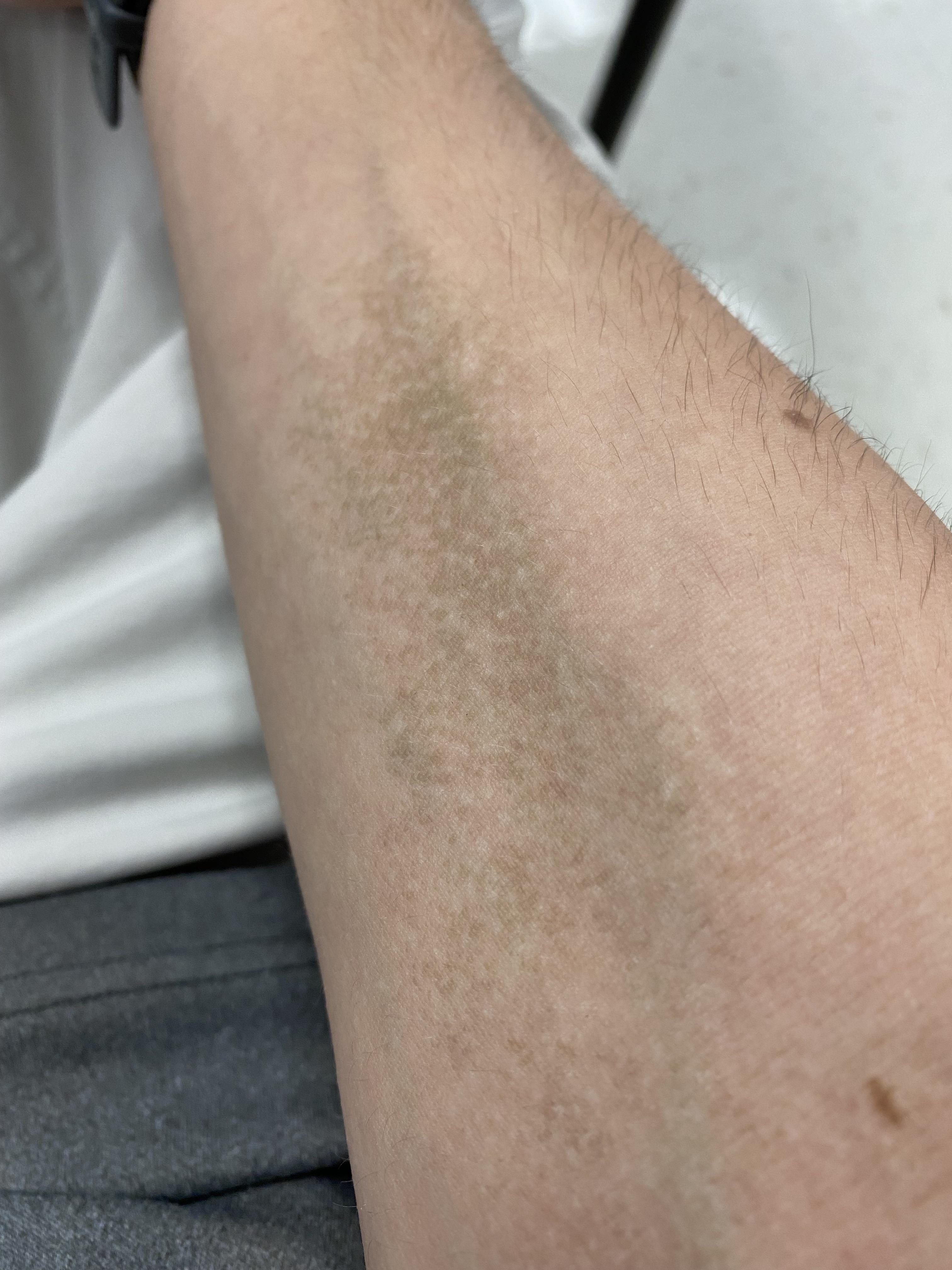 Doctors and dermatologist of Reddit, what is this on my skin of my