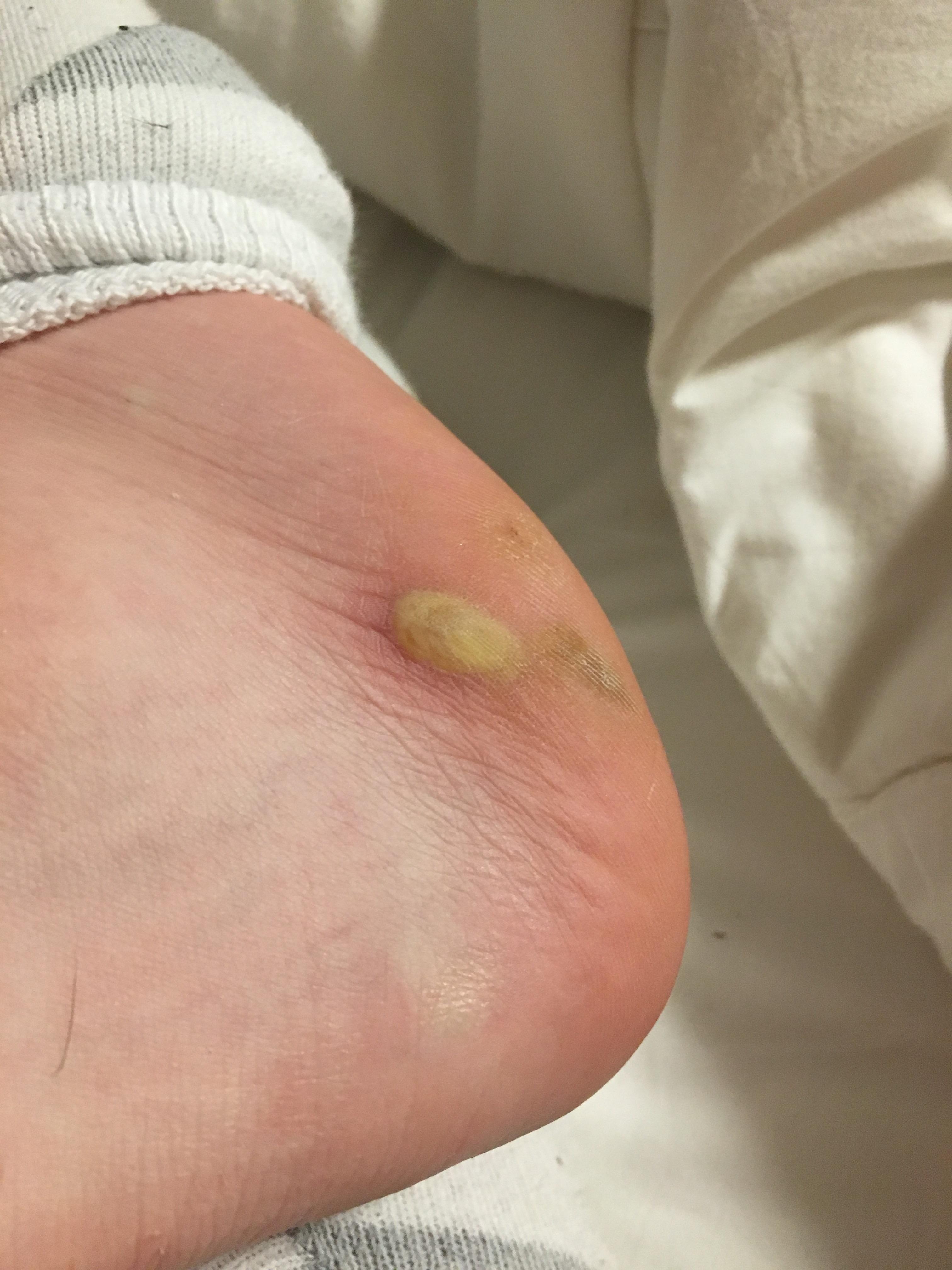 I want to pop this blister sooo bad! (Yes I know not to do that) r