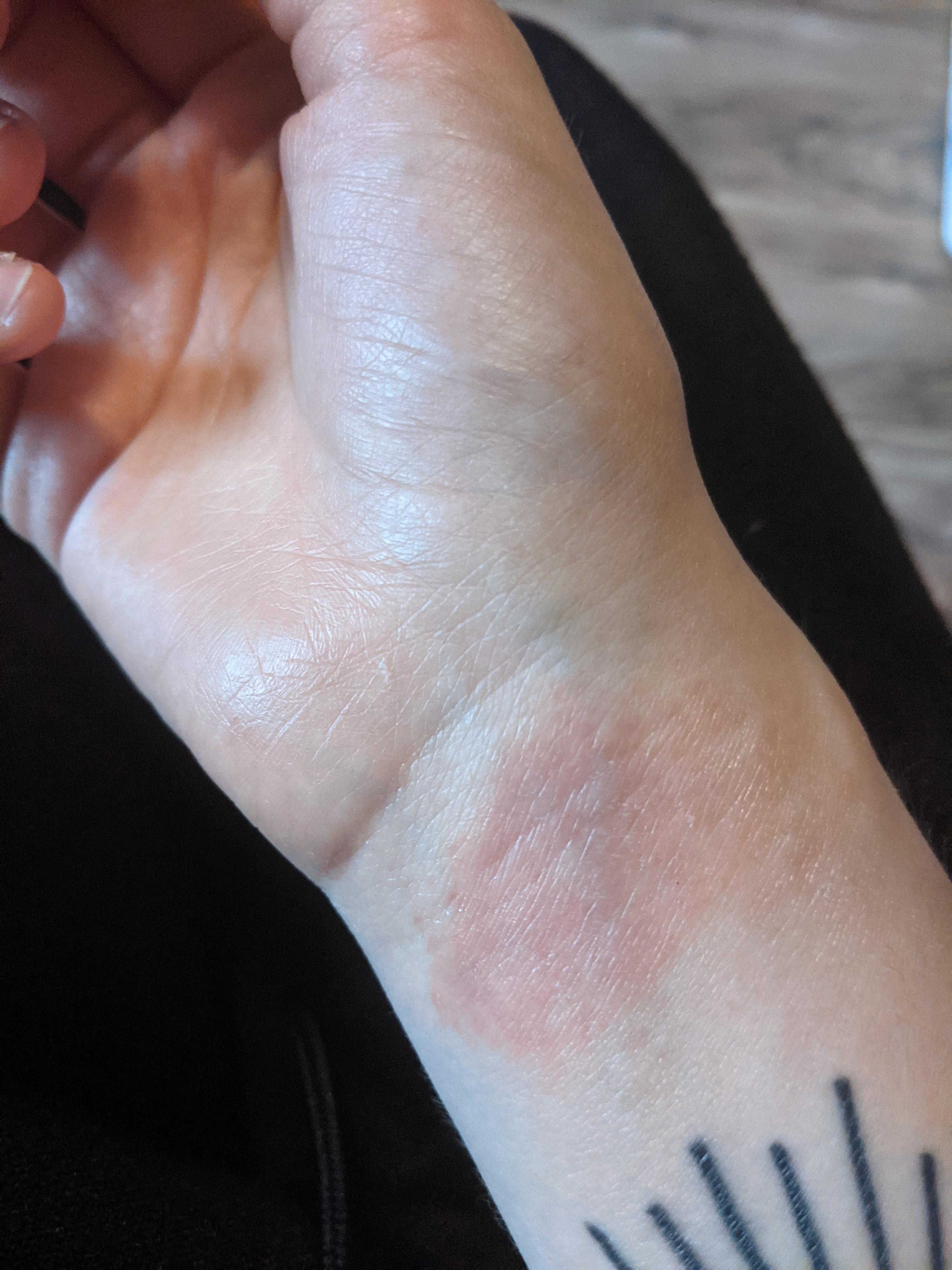 Does birth control make ringworm worse? ringworm