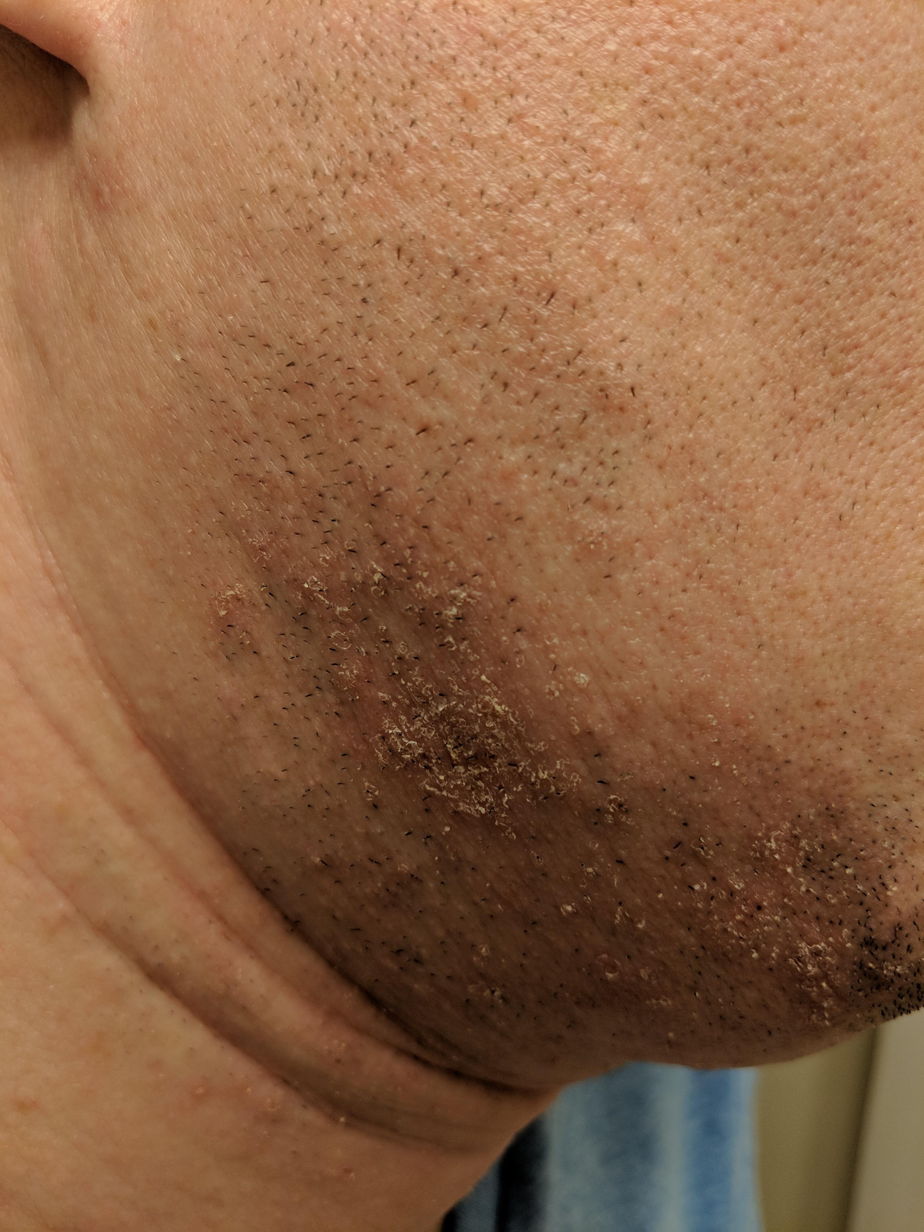 Razor bumps? r/wicked_edge