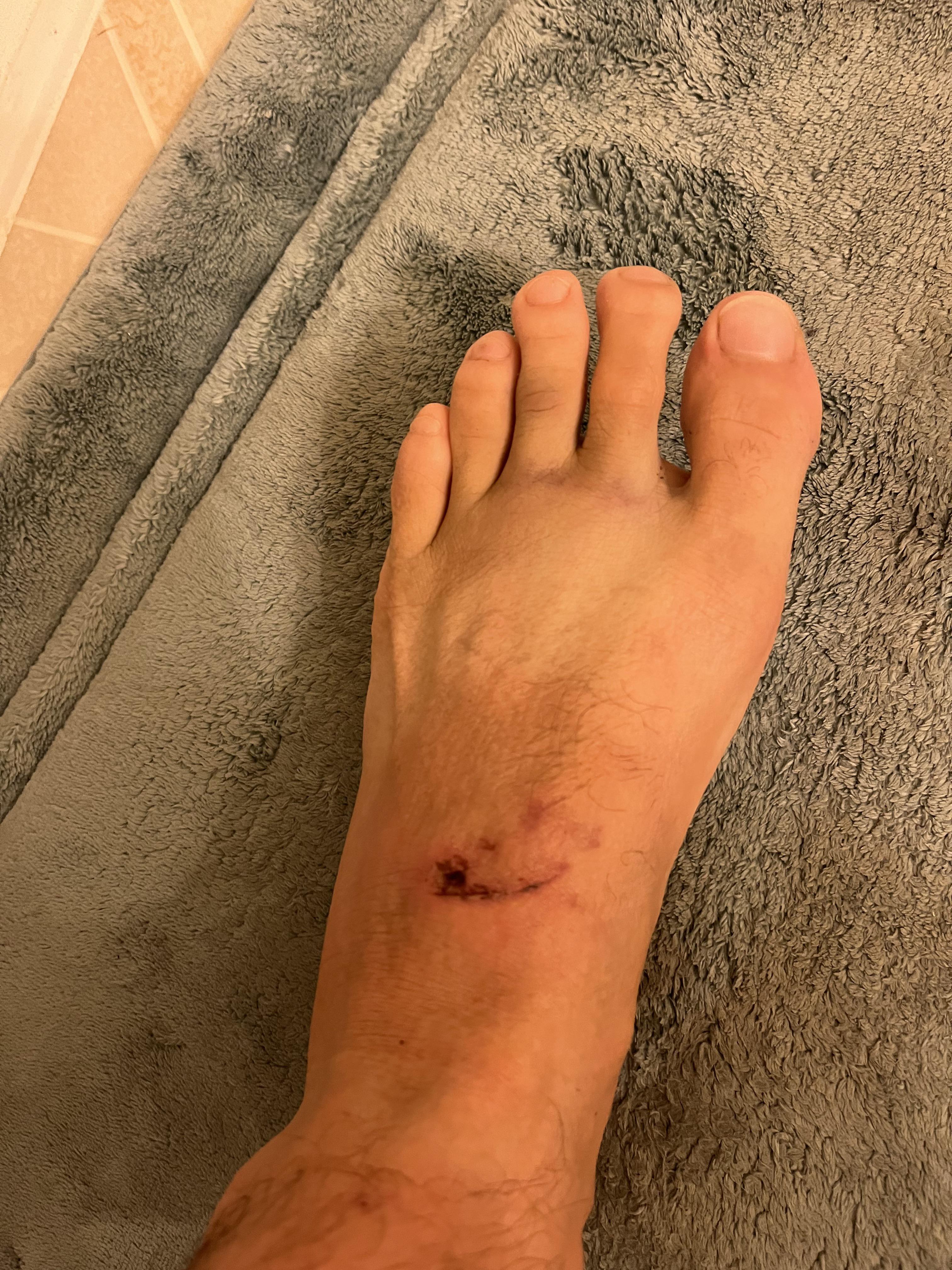 Item fell on foot (question in comments) r/medical