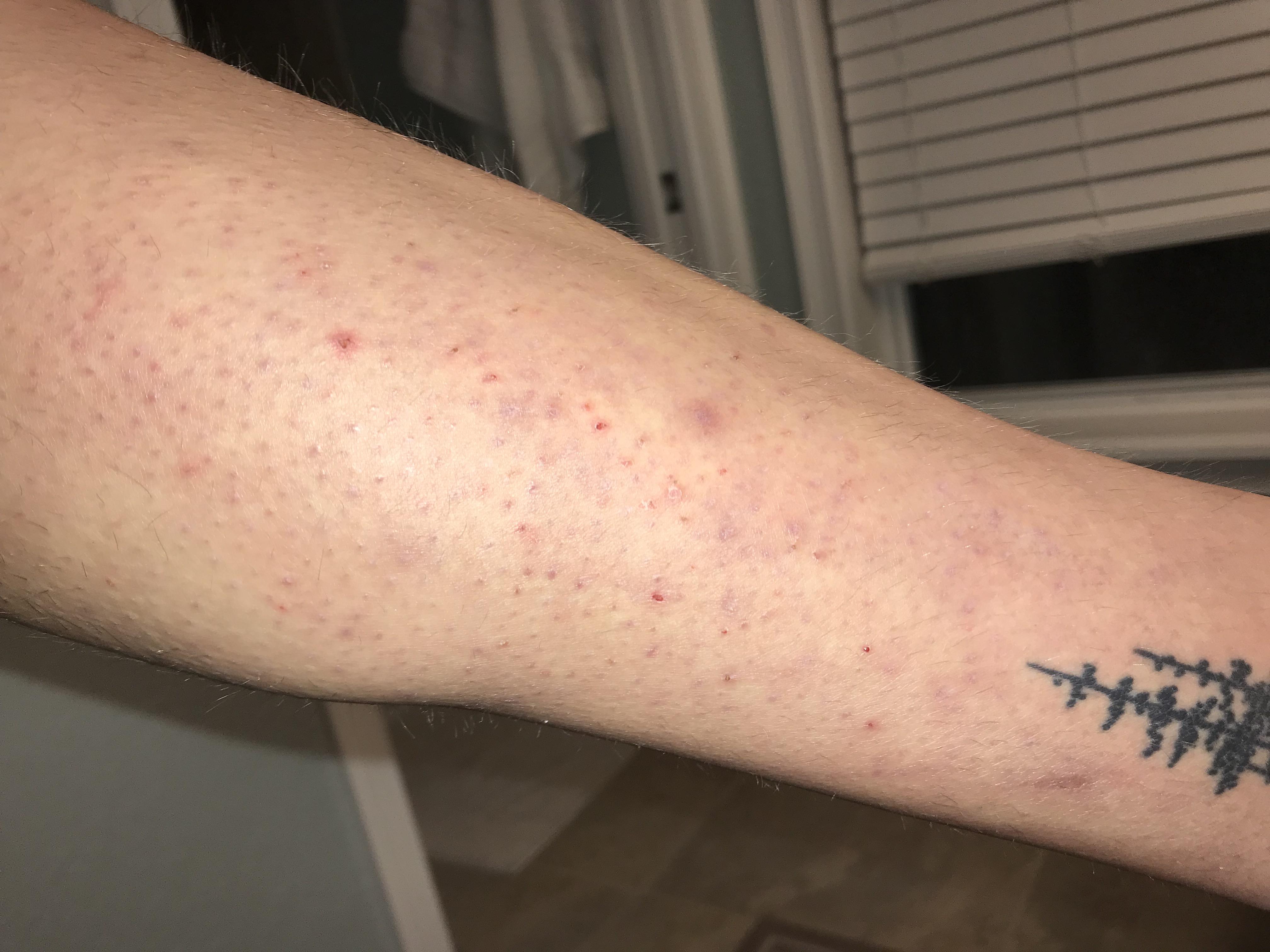 Scarring/Hyperpigmentation from picking/ingrown hairs all over legs