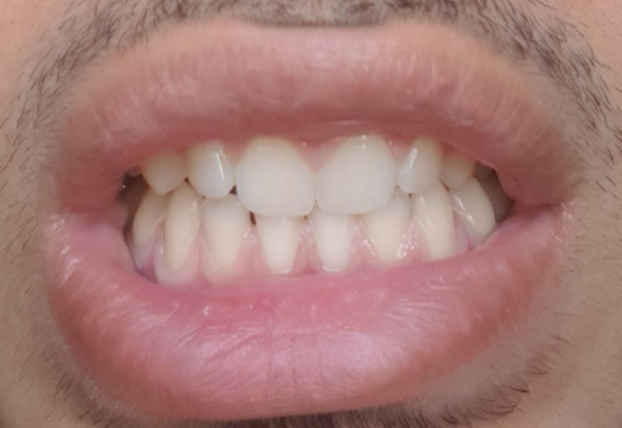 When my mouth is closed my teeth usually look like these, not aligned