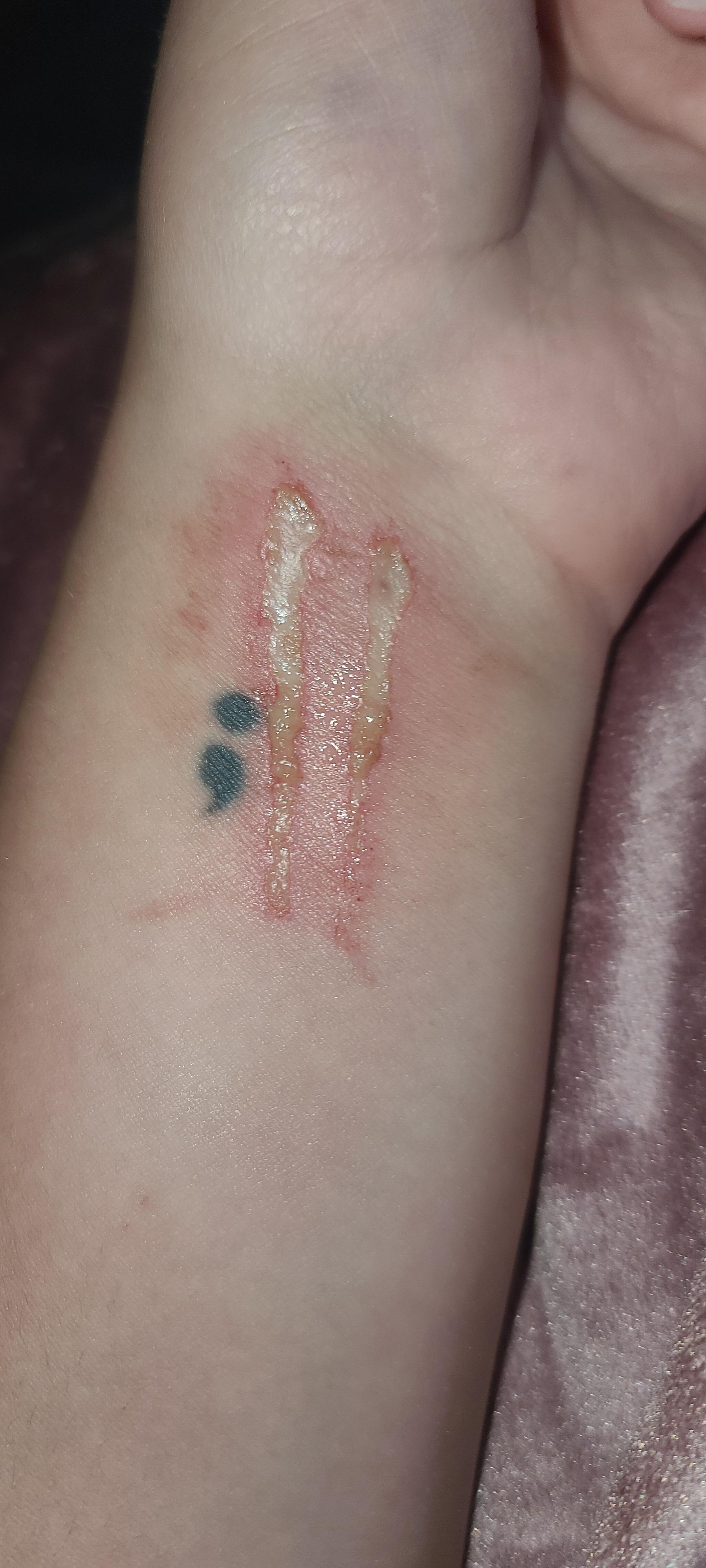 Recent skin abrasion; is this infected? r/DiagnoseMe