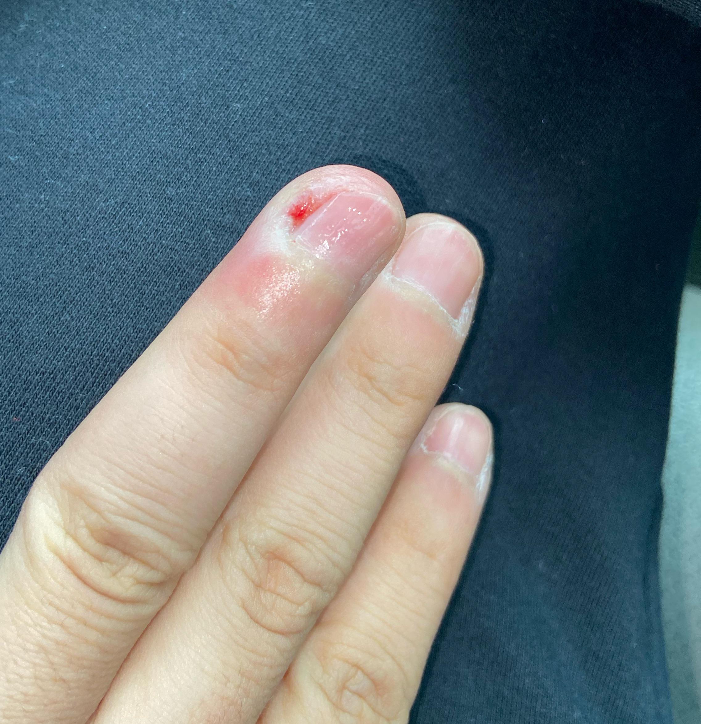 Ingrown fingernail any tips? r/Ingrown_Toenails