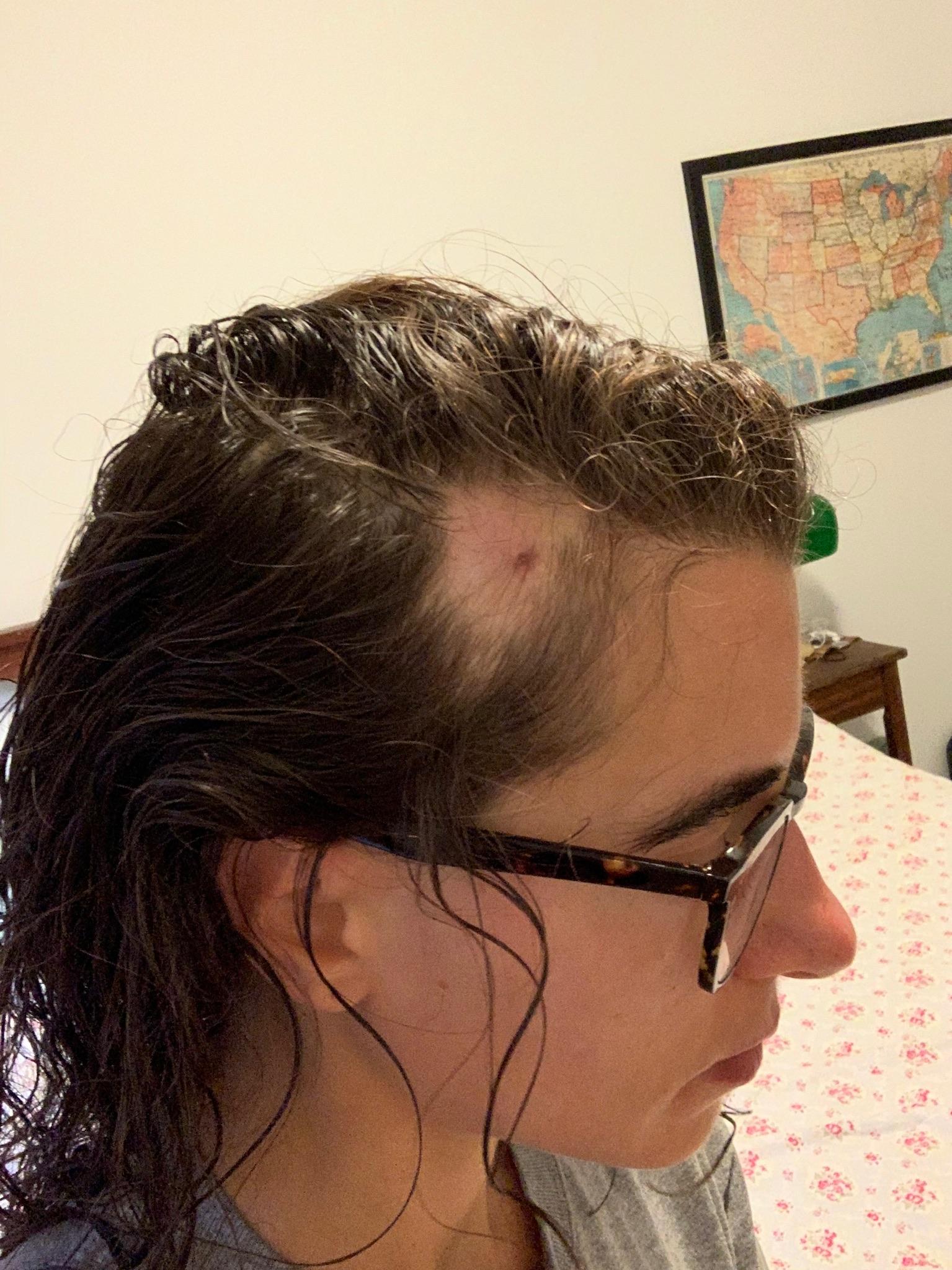 31 year old female, rapid hair loss on right side alopecia_areata