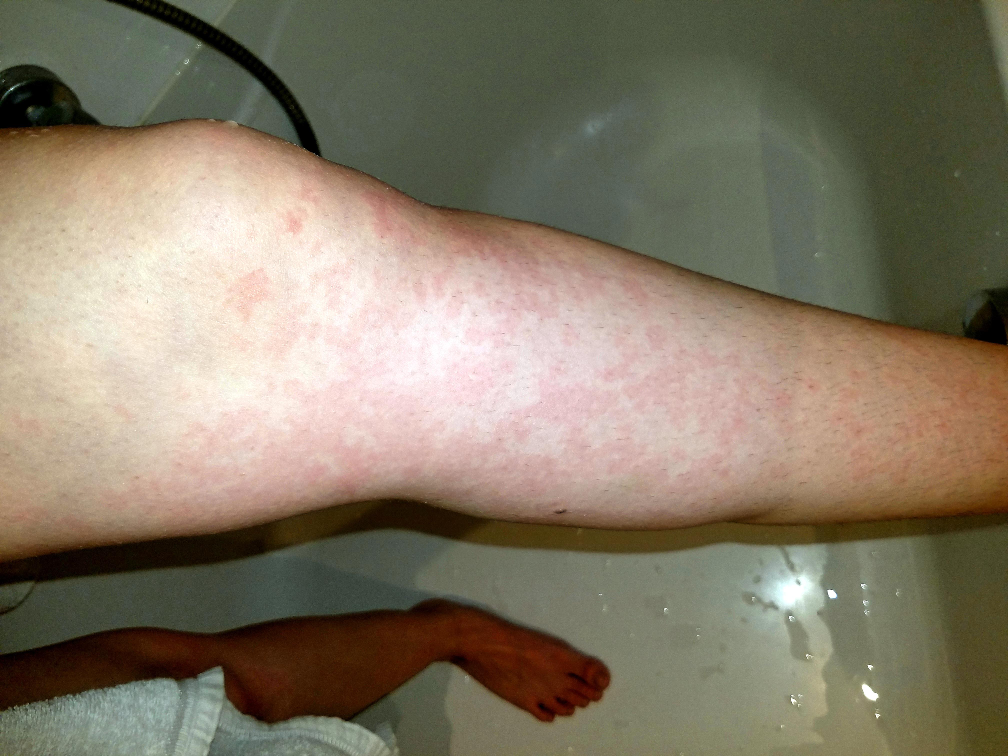 Does anyone else get these red splotches from showering? I've never