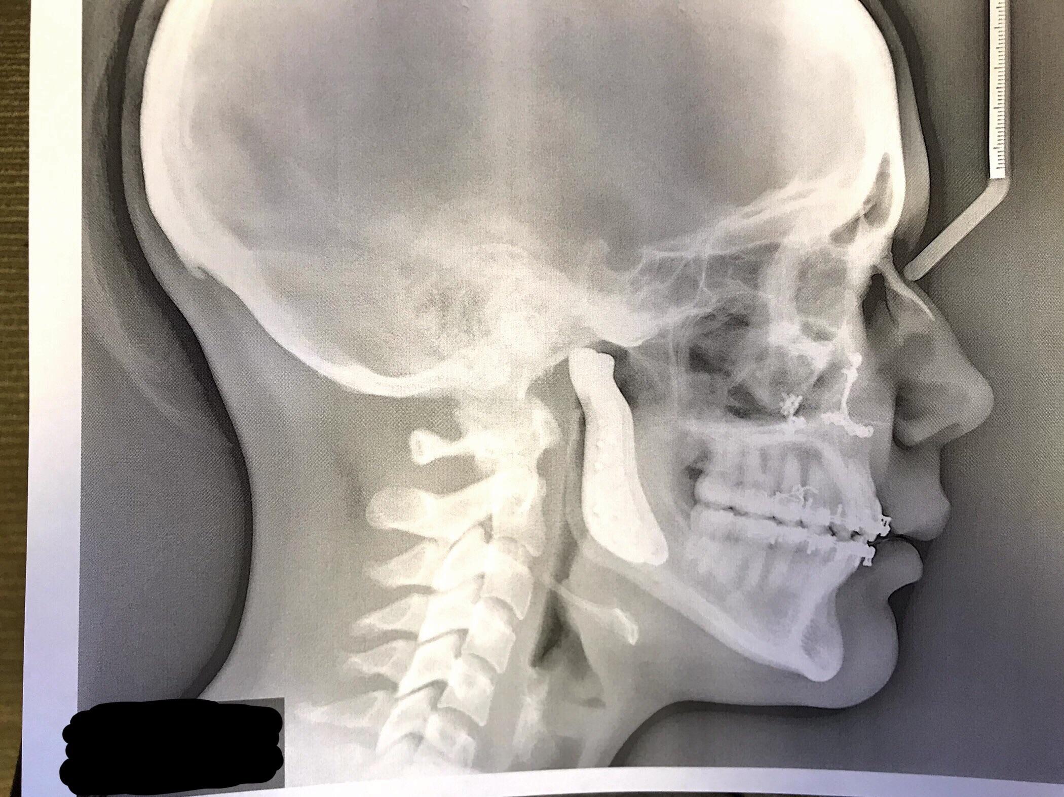 XRay of total TMJ replacement and upper jaw surgery. r/jawsurgery