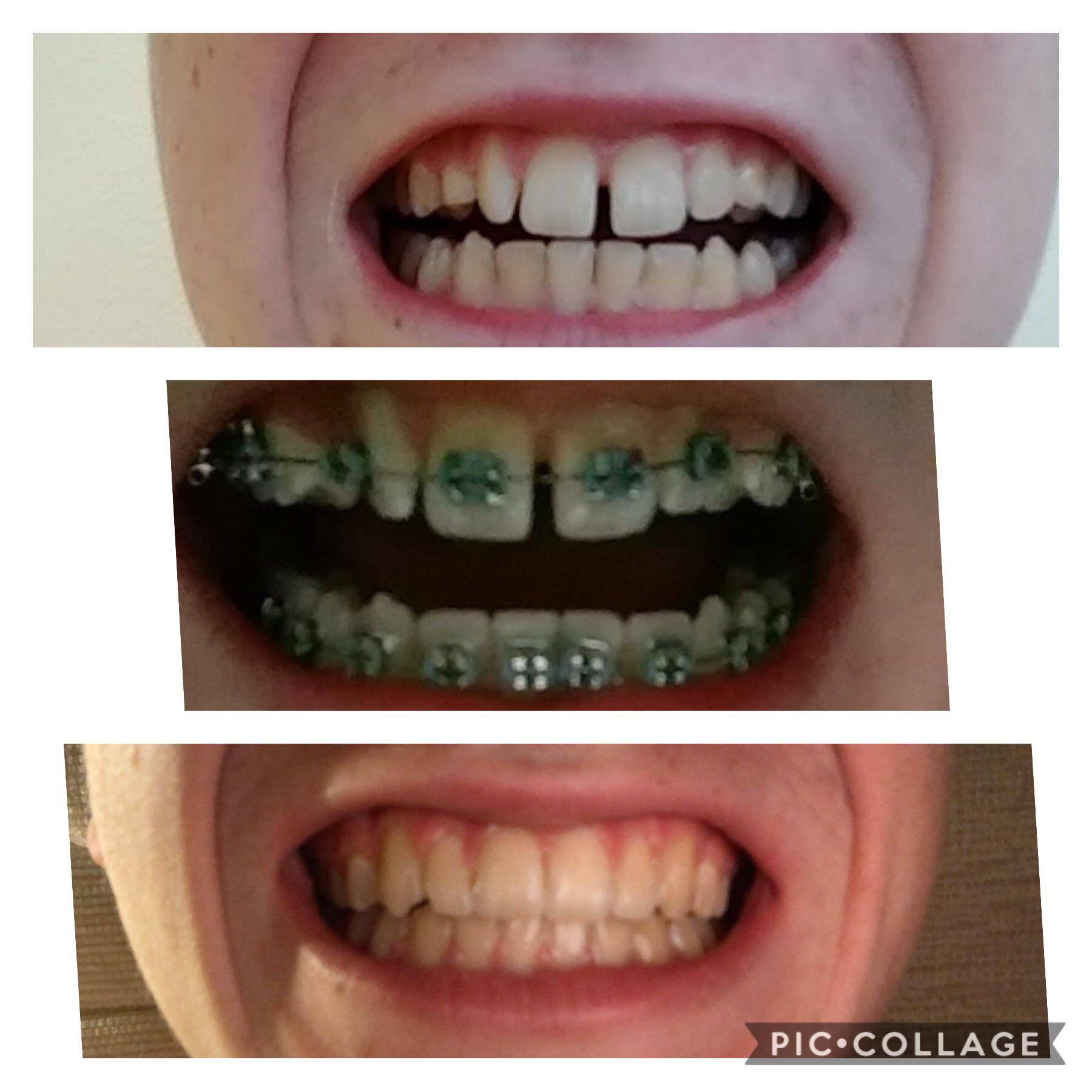 Braces are definitely worth it ) r/braces