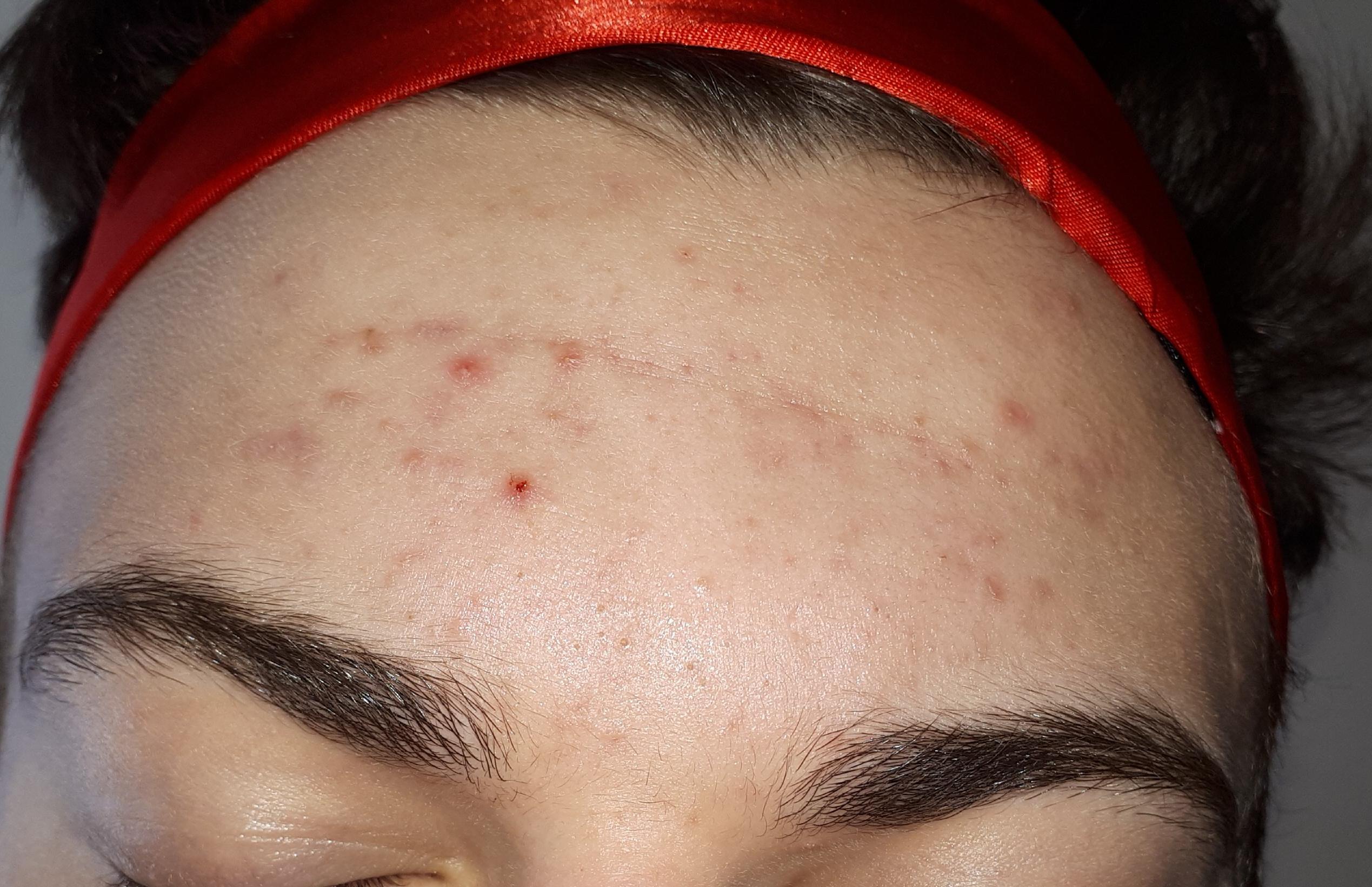 Benzoyl Peroxide Vs Salicylic Acid Reddit