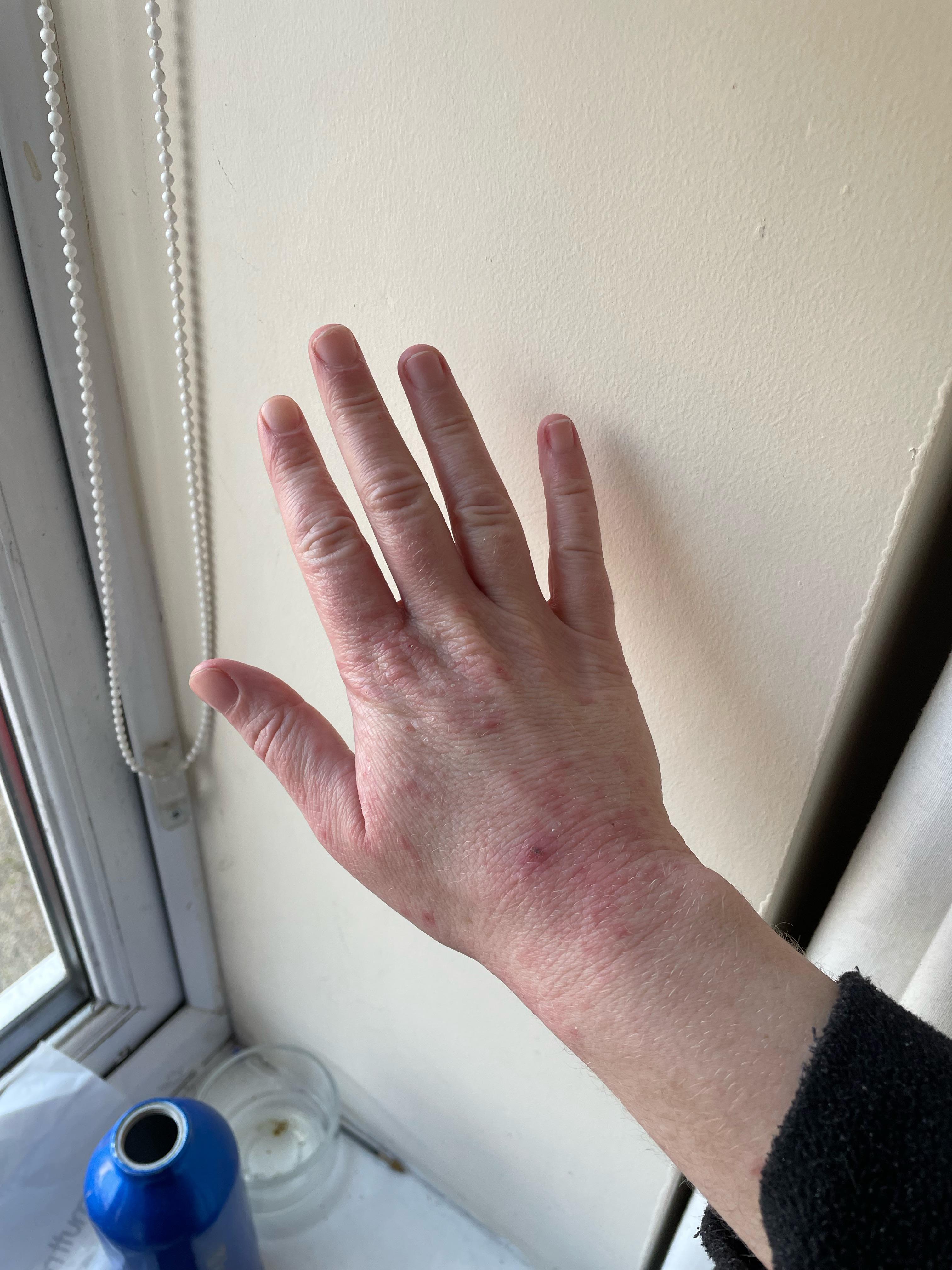 Eczema hands😍. Gotta love having the hands of an 80yr when you’re only