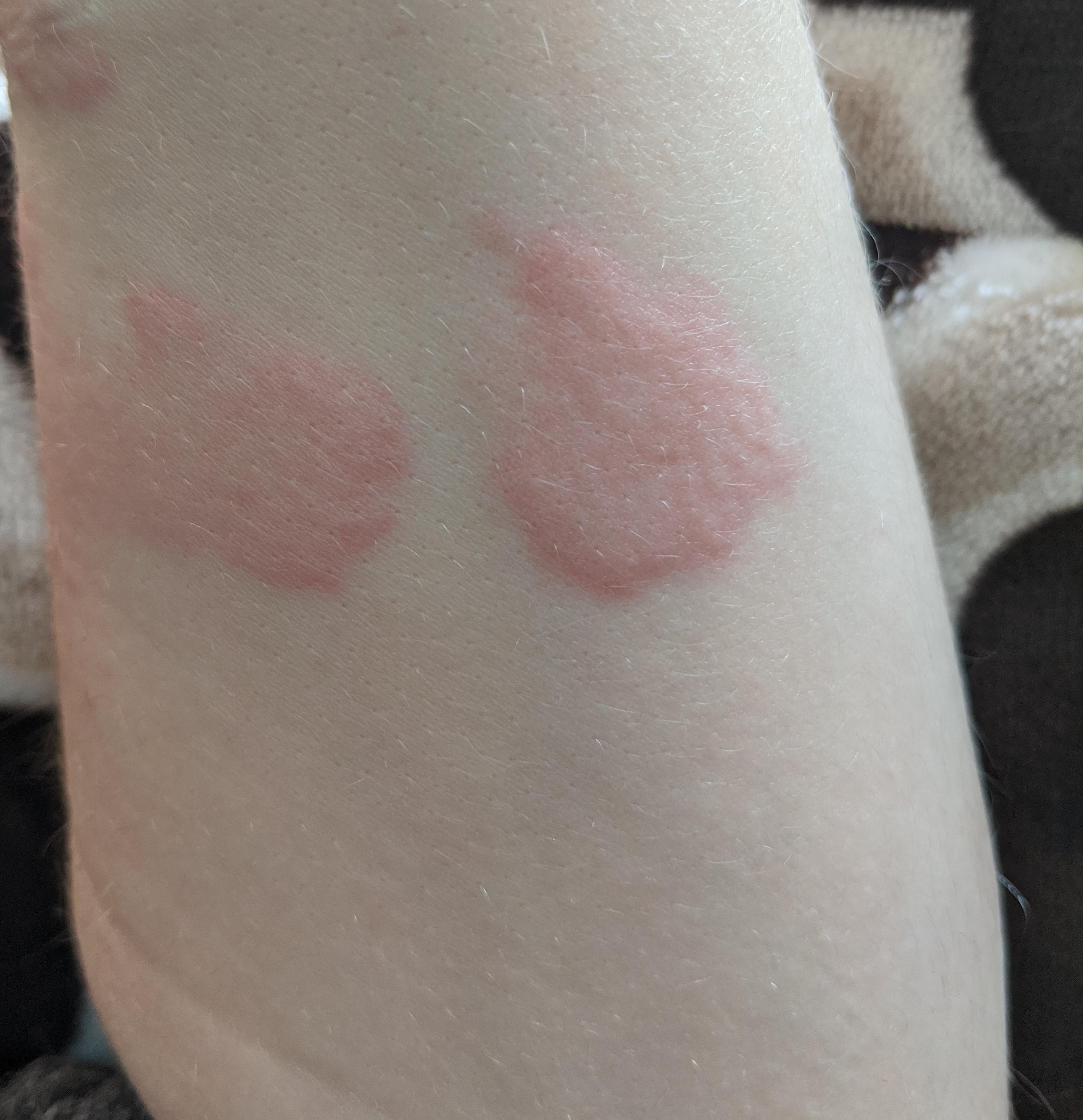 The fish oil that has seemed to cure my hives urticaria