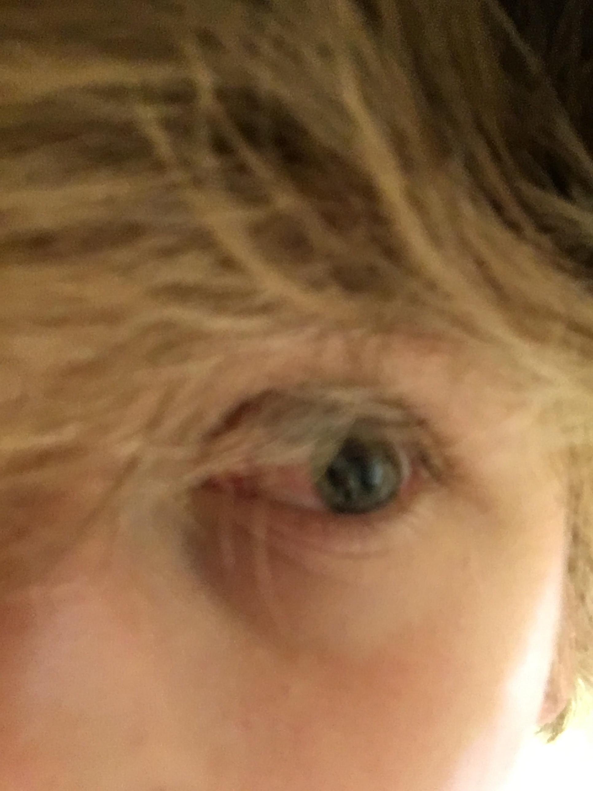 My eye is red around the cornea. Idk if it’s due to my sneezing or if I