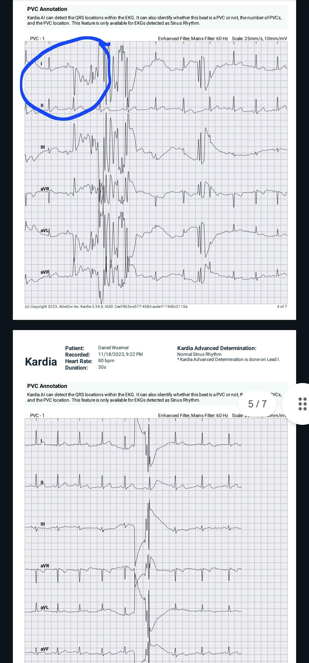 Inverted QRS?? r/ReadMyECG