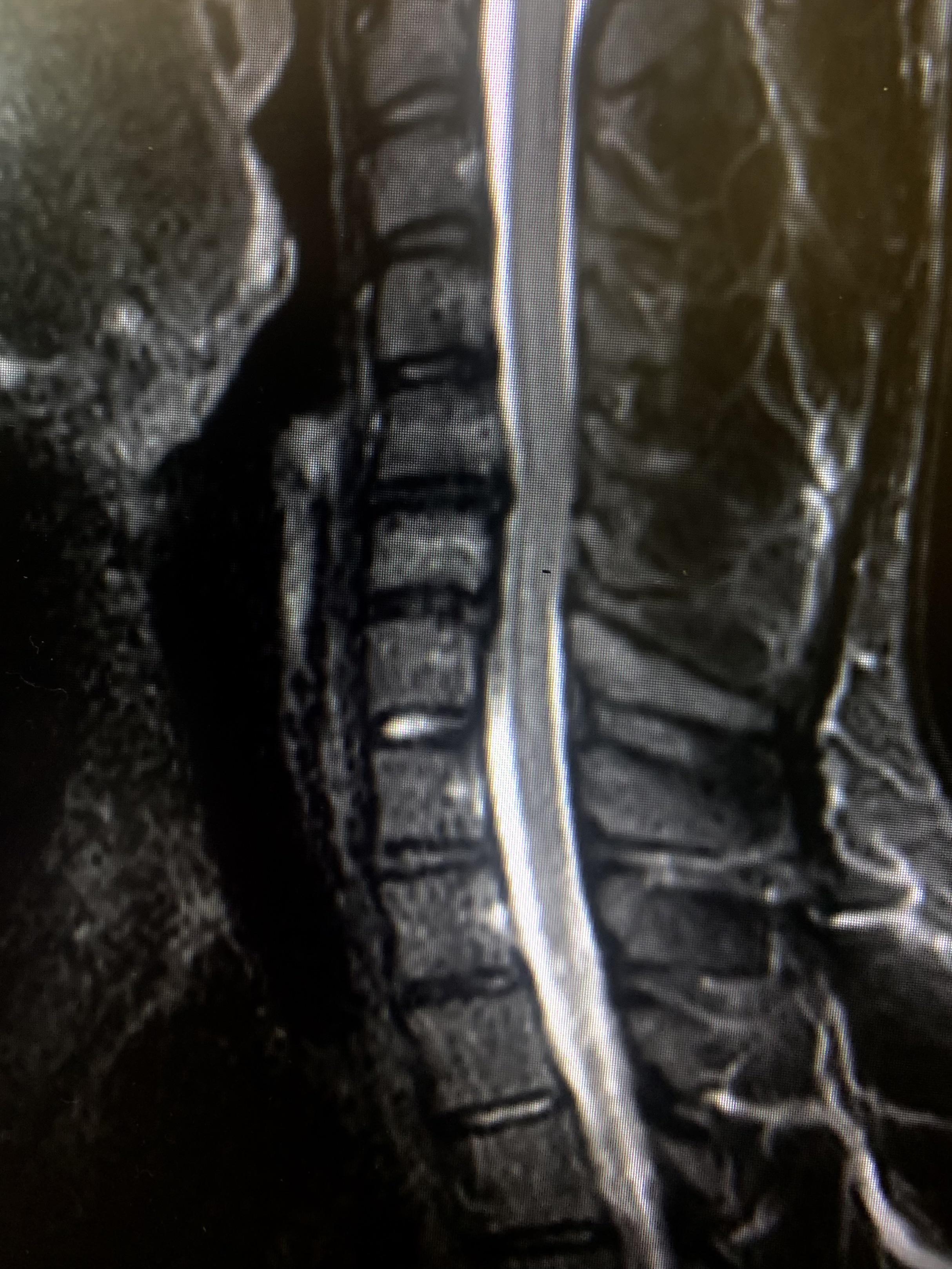Is surgery necessary? C5/C6, C6/C7 both disc bulges… symptoms neck pain