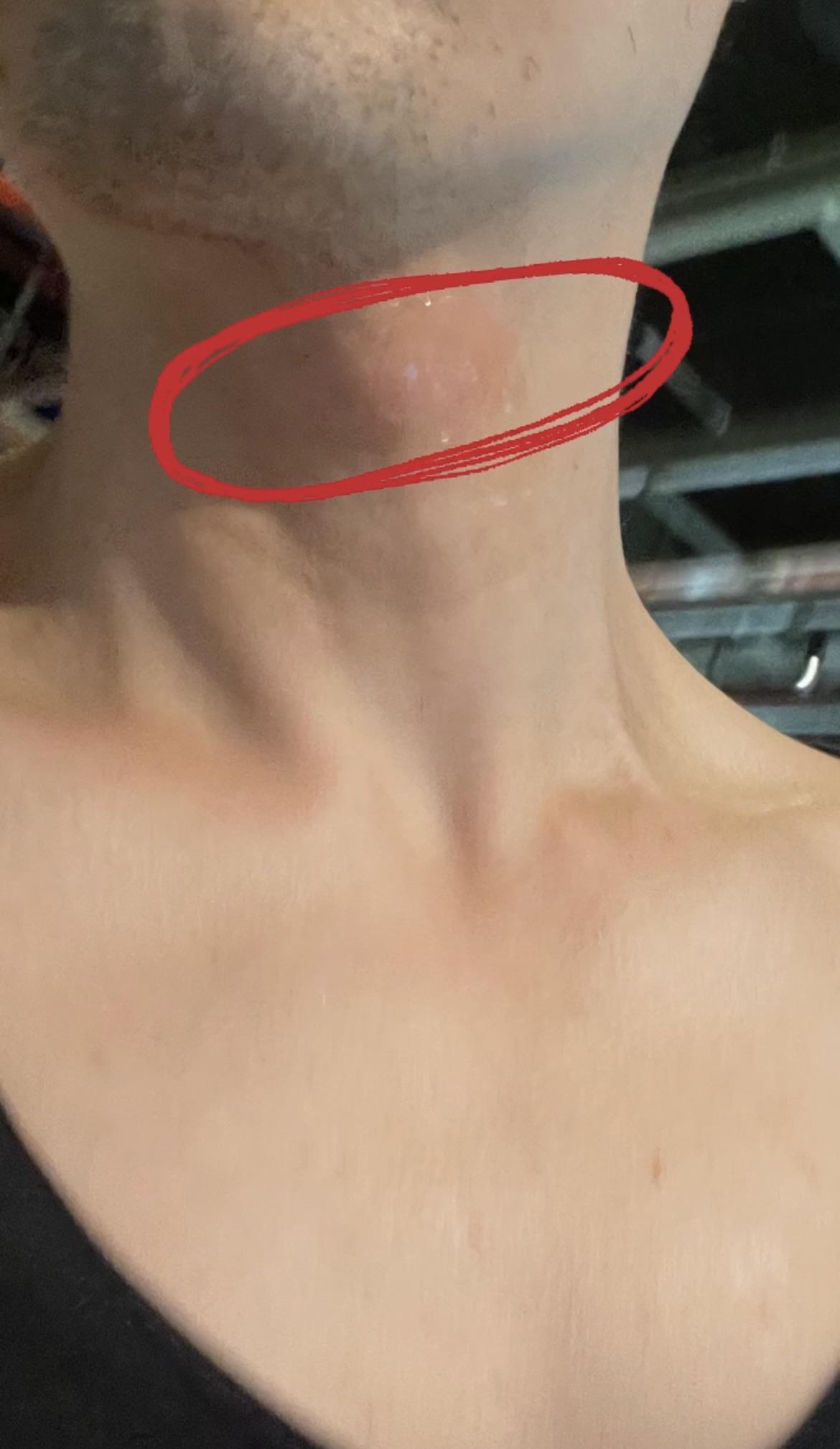 Is there any insect that loves to bite my Adam’s apple/ neck either