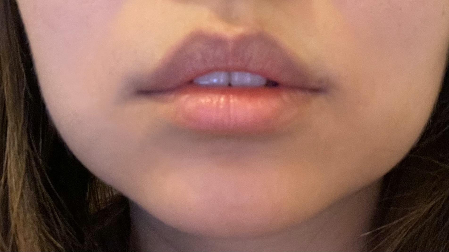 Lip can’t fully close my mouth. I had braces for years and my orthodontist said