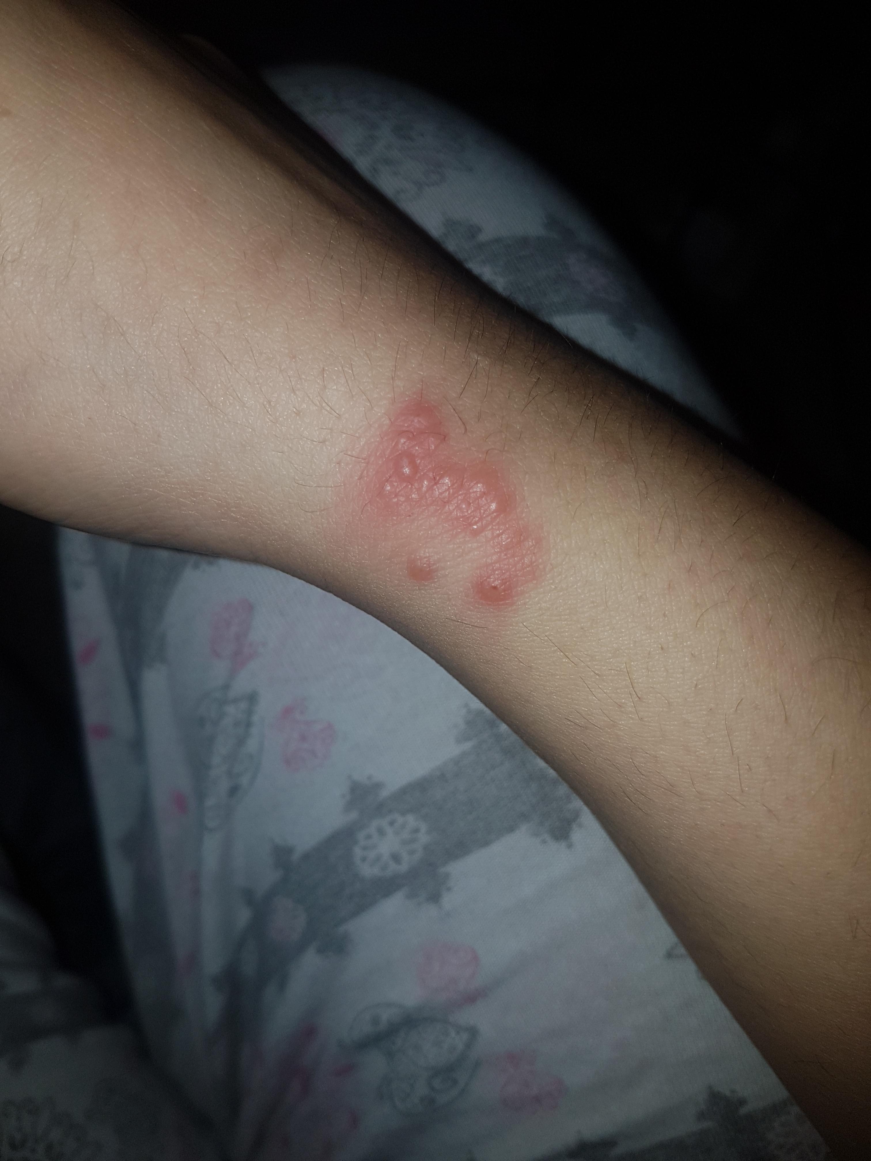 What is this cluster of blisters on my wrist? It is painful but not