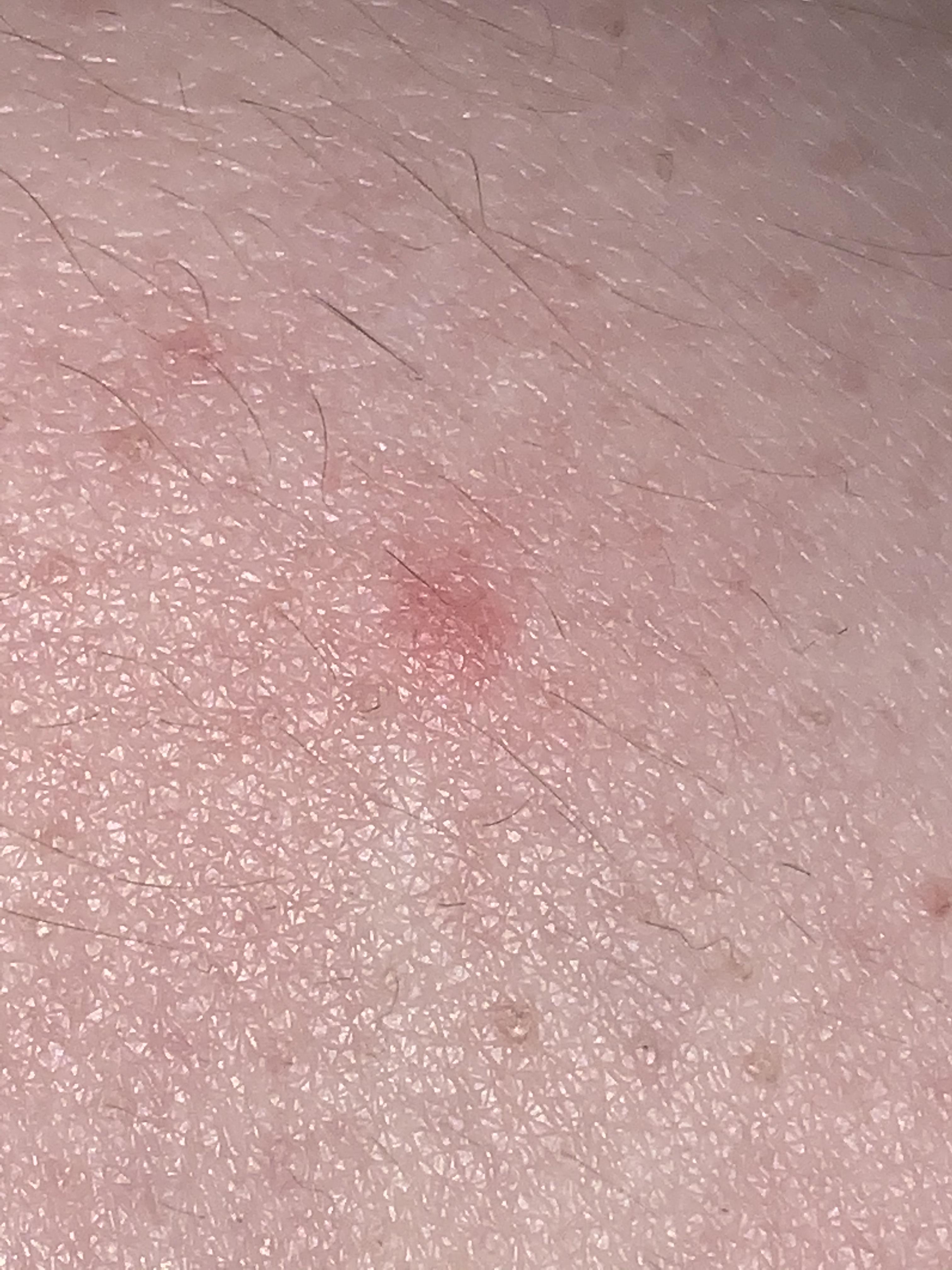 What is this bump? Pimple? Ingrown hair? Folliculitis? Bug bite? r