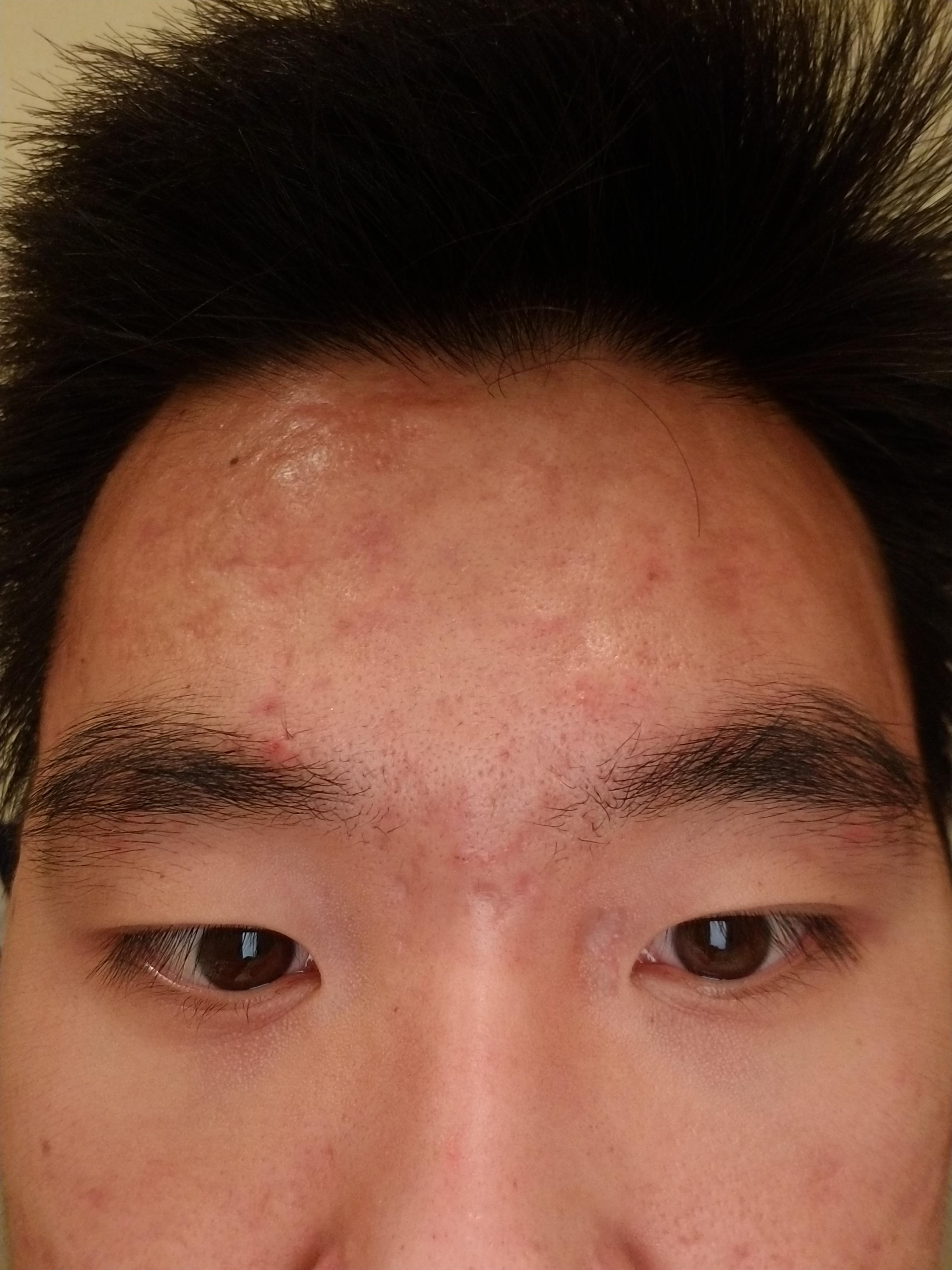 [Acne] how to get rid of huge bumpy scars caused by acne? r